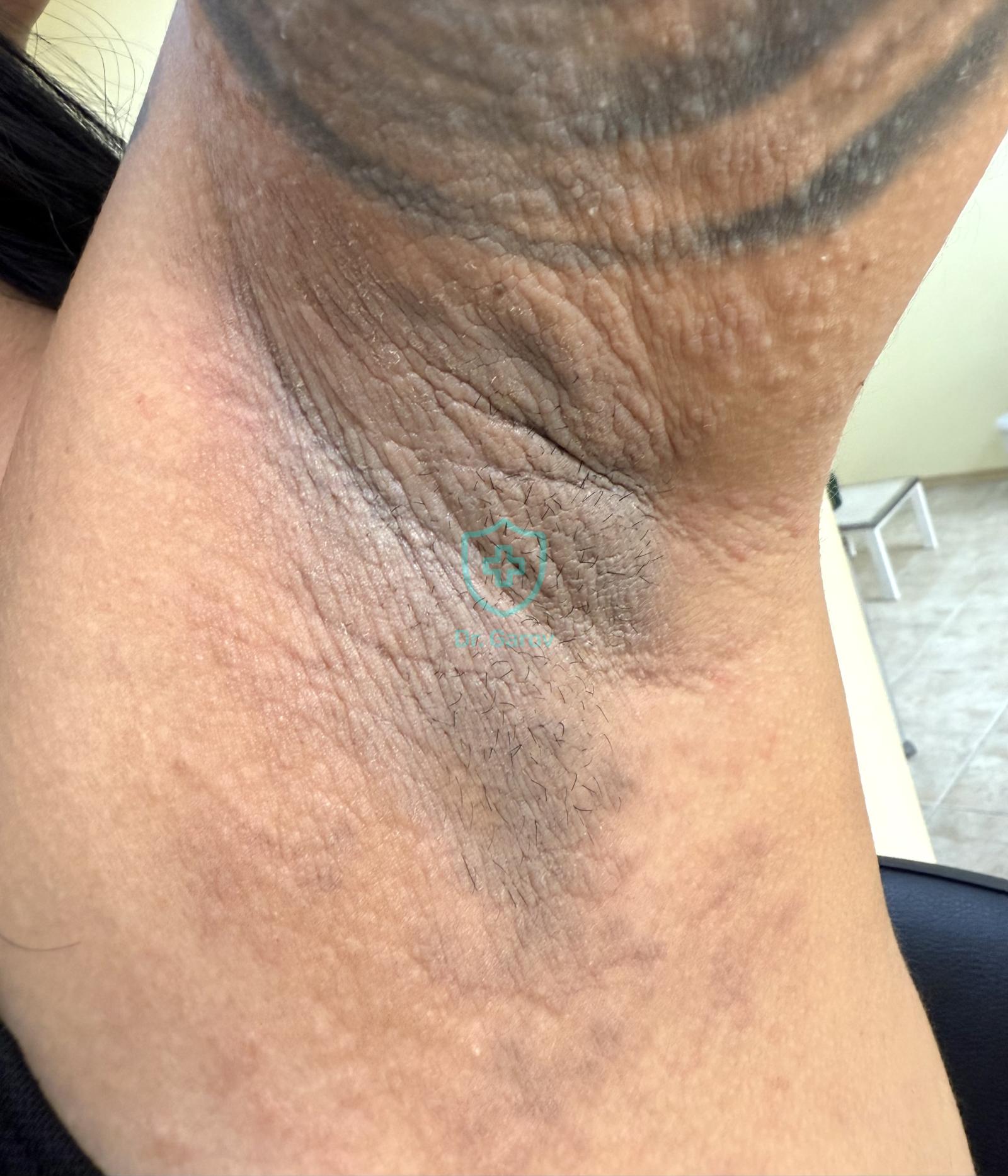 Acanthosis nigricans