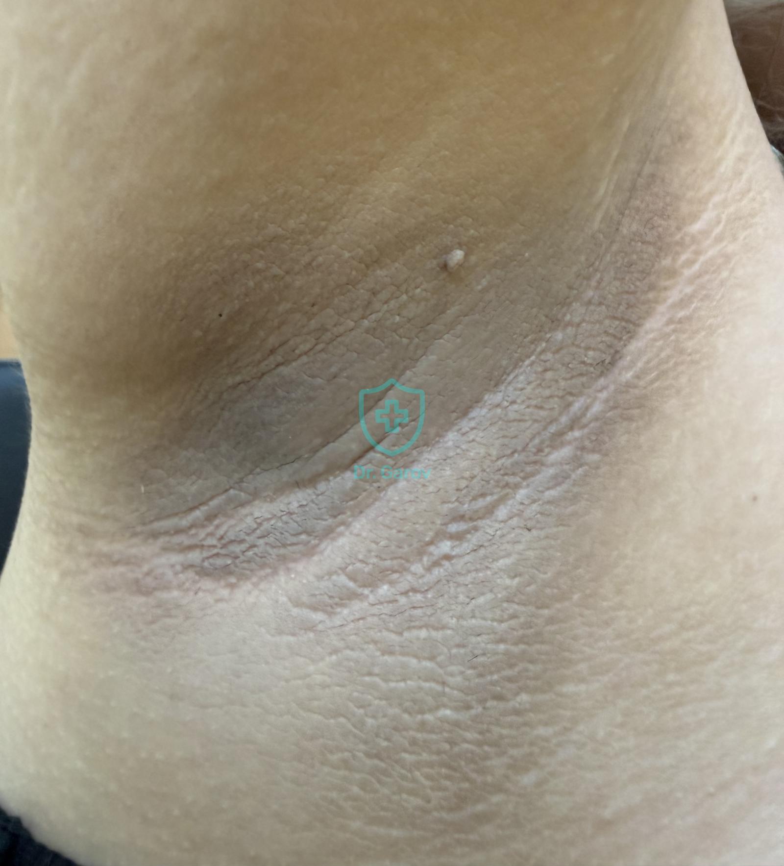 Acanthosis nigricans