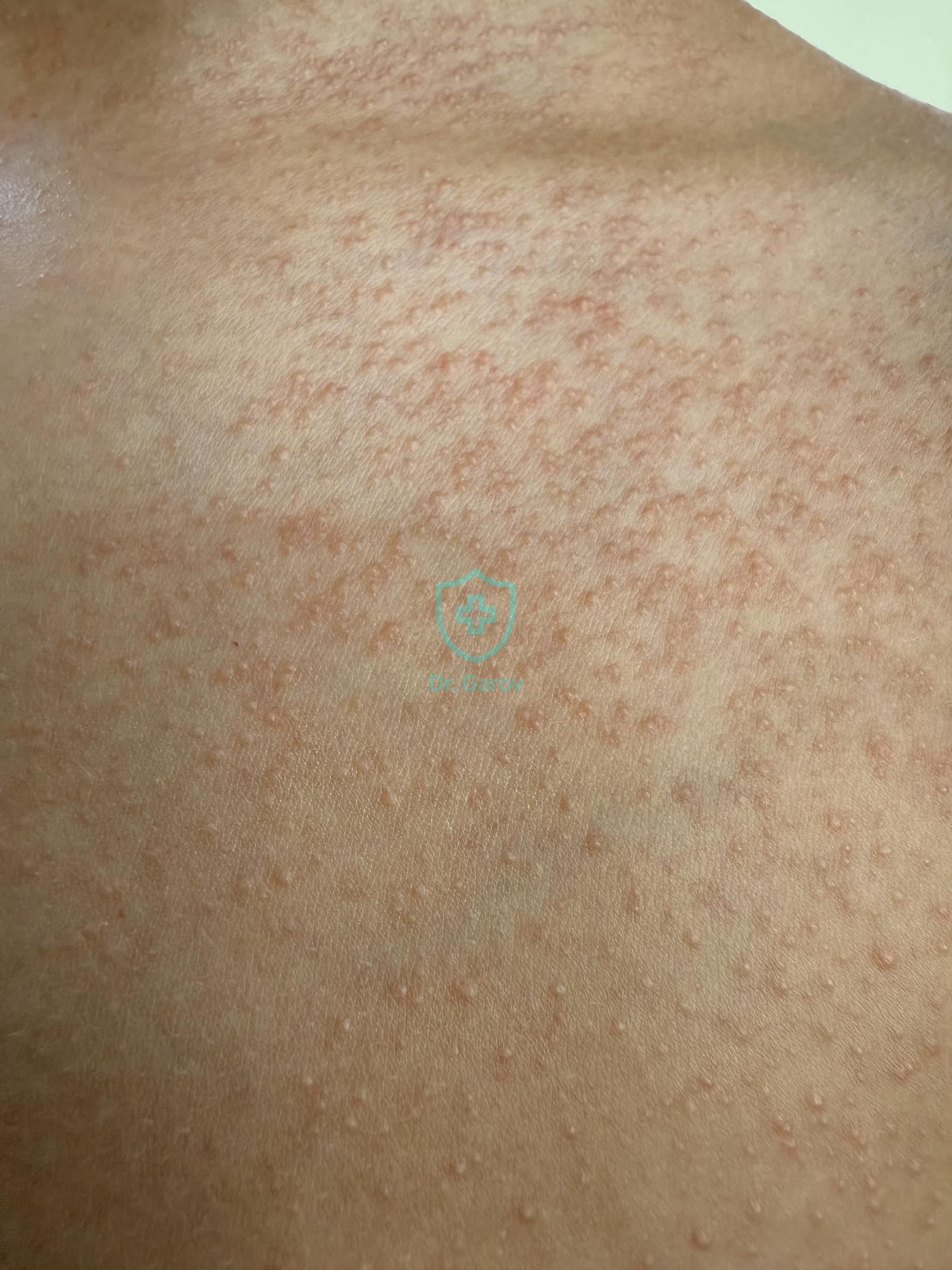 Acne solaris