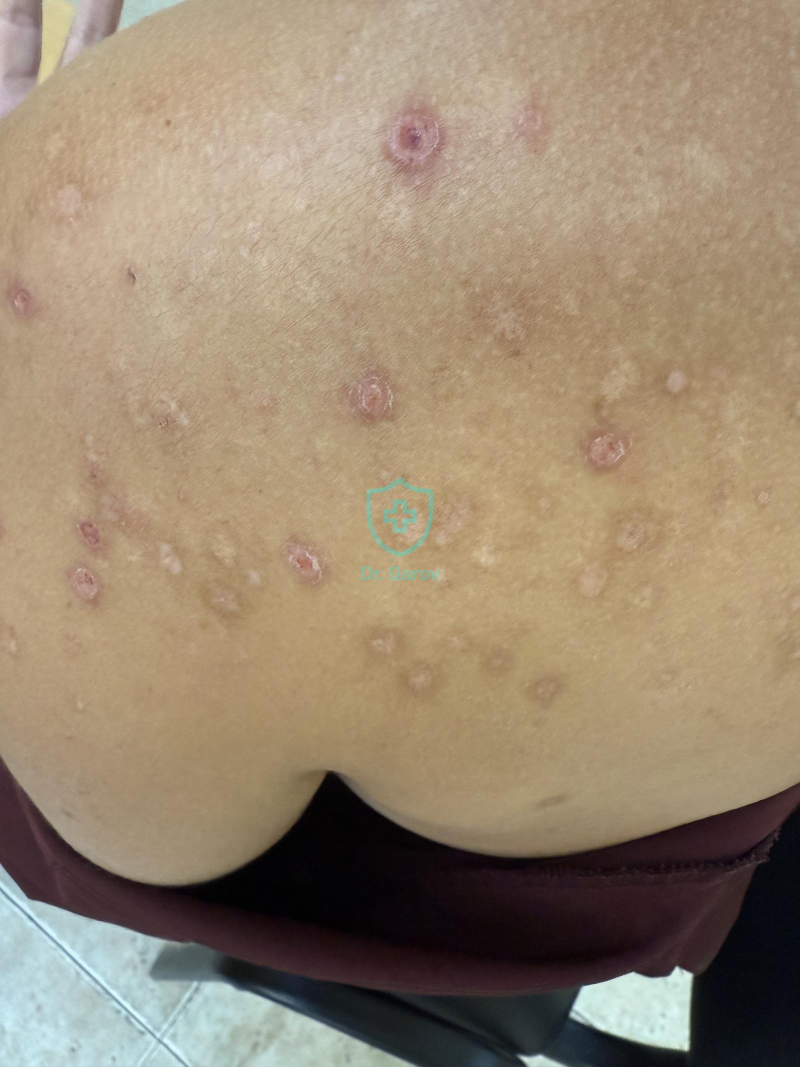 Acne excoriata