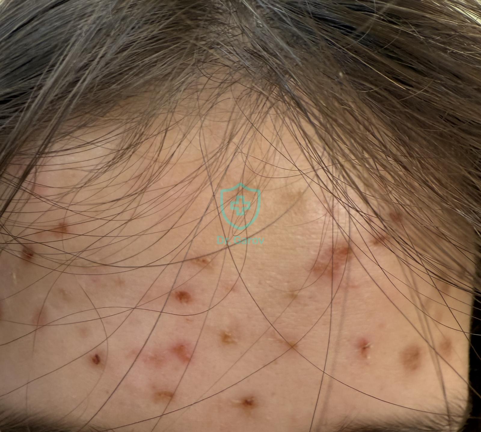 Acne excoriata