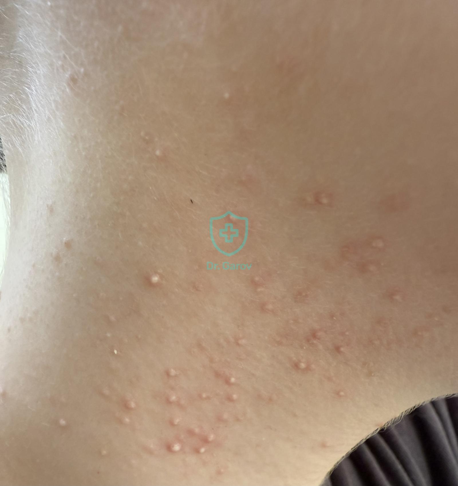 Acne papulo-pustulosa