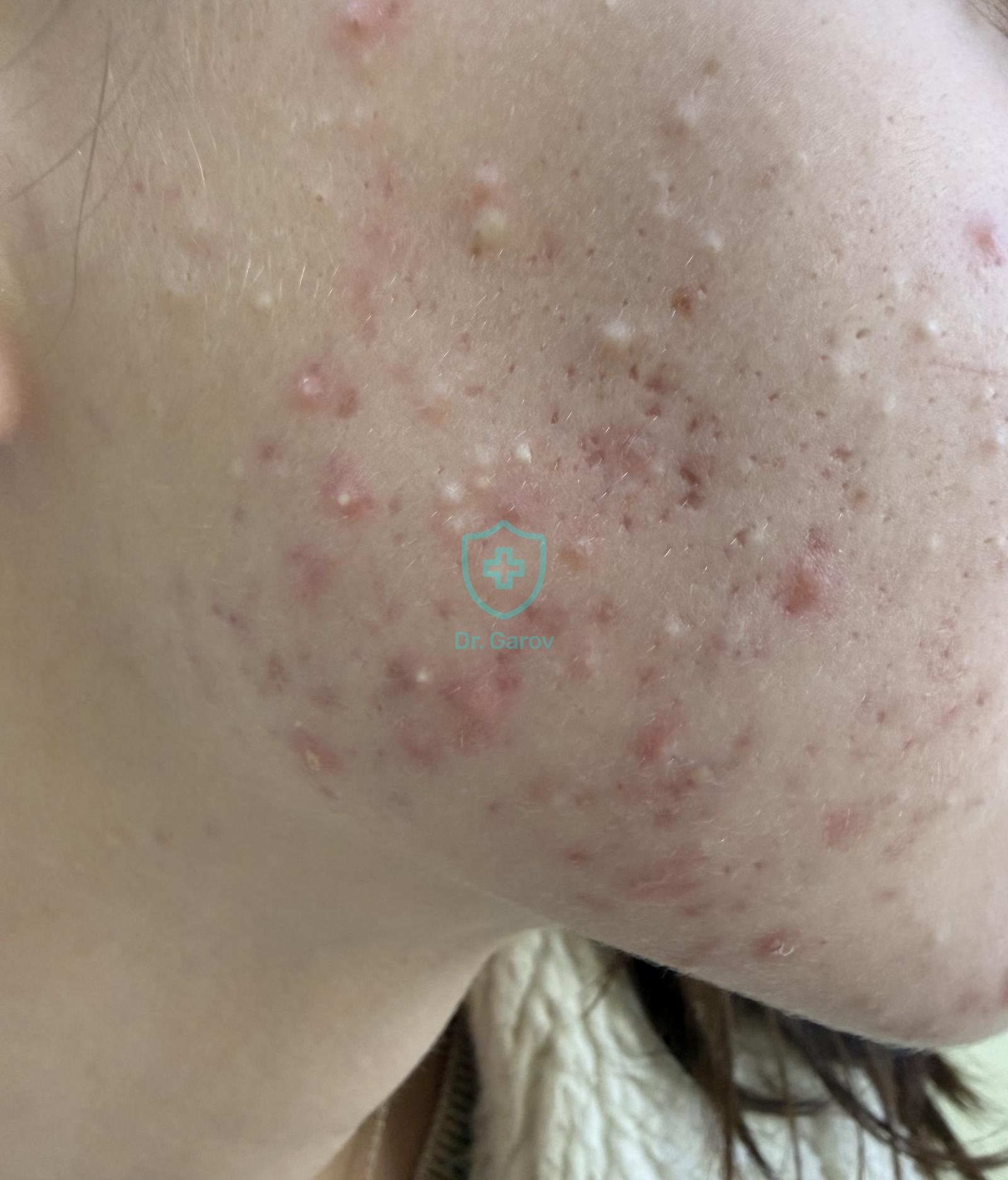 Acne papulo-pustulosa