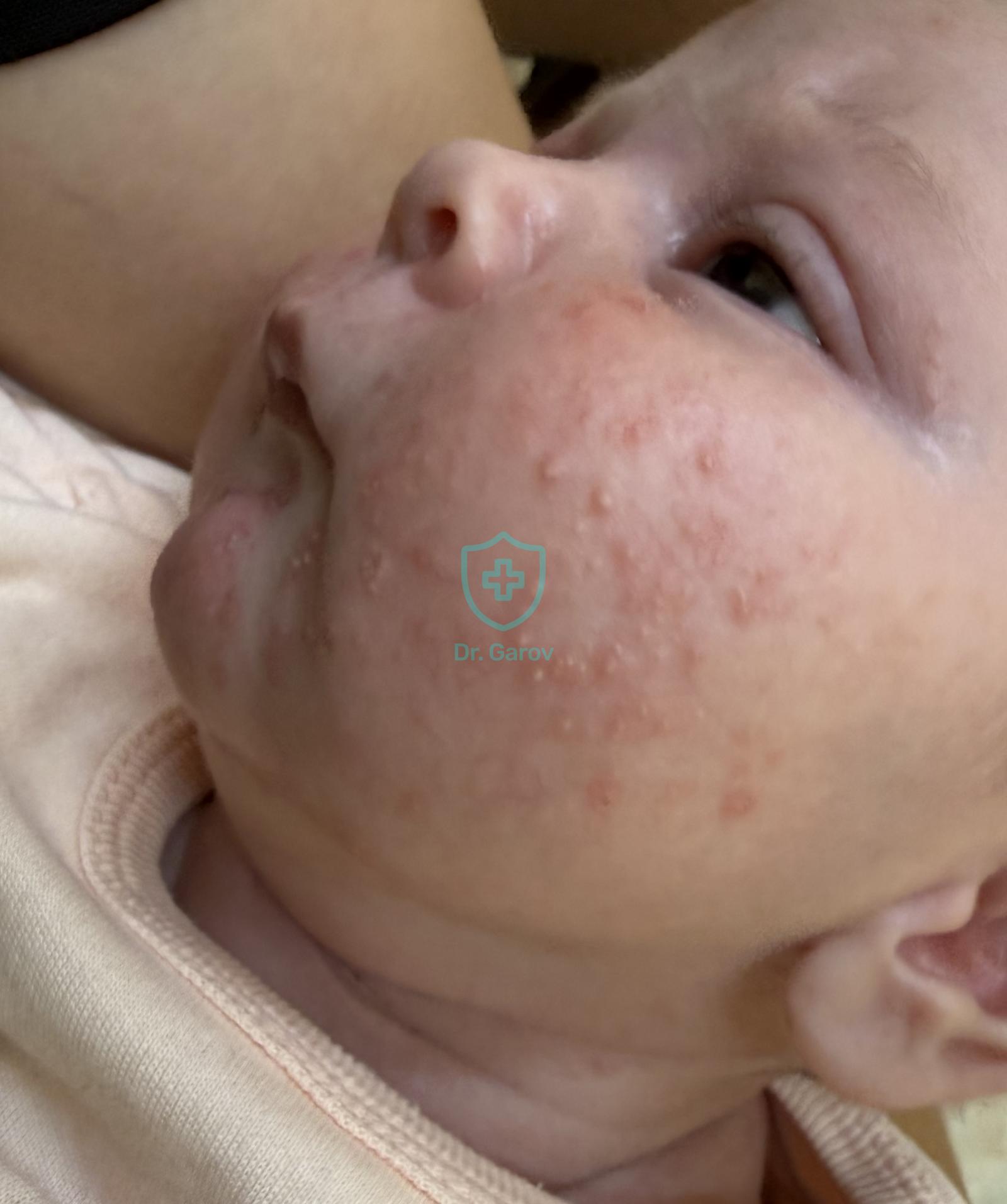 Acne neonatorum