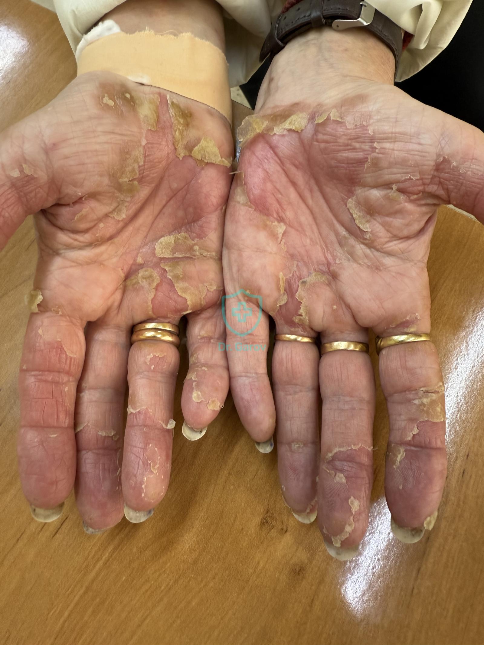 Dermatitis contacta allergica
