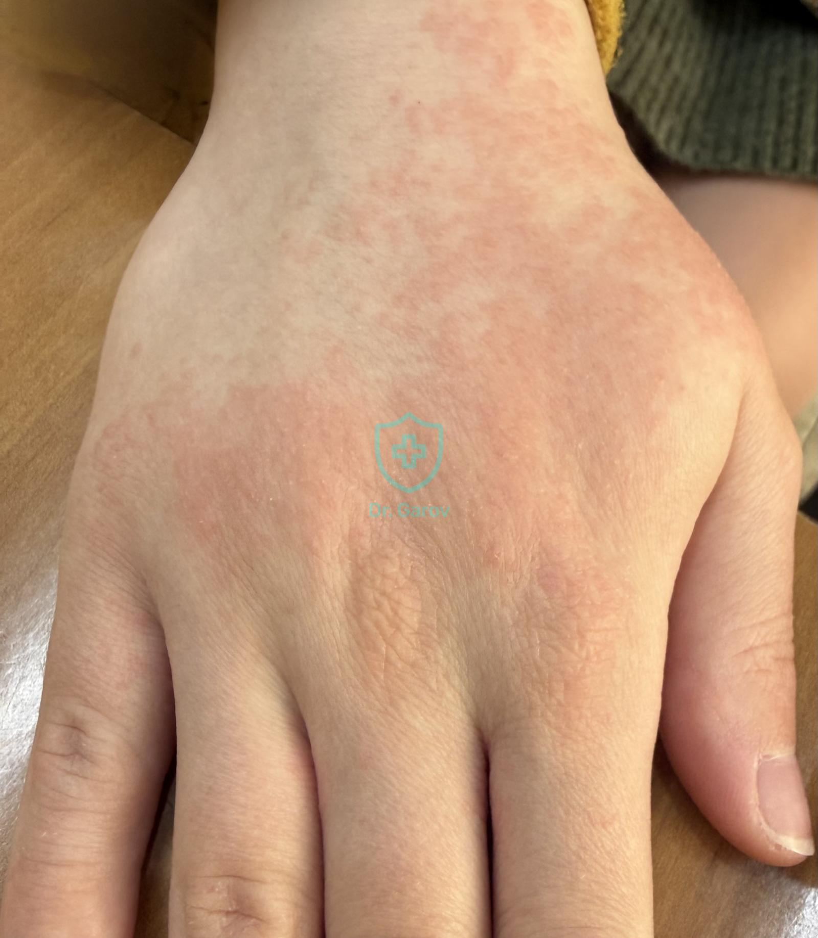 Dermatitis contacta allergica