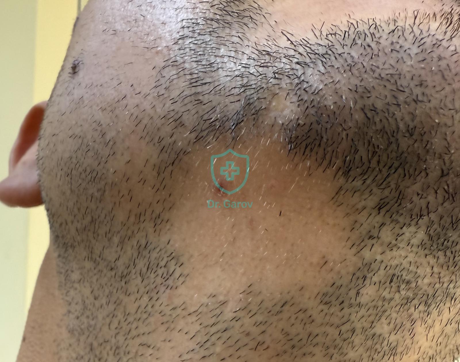 Alopecia areata barbae