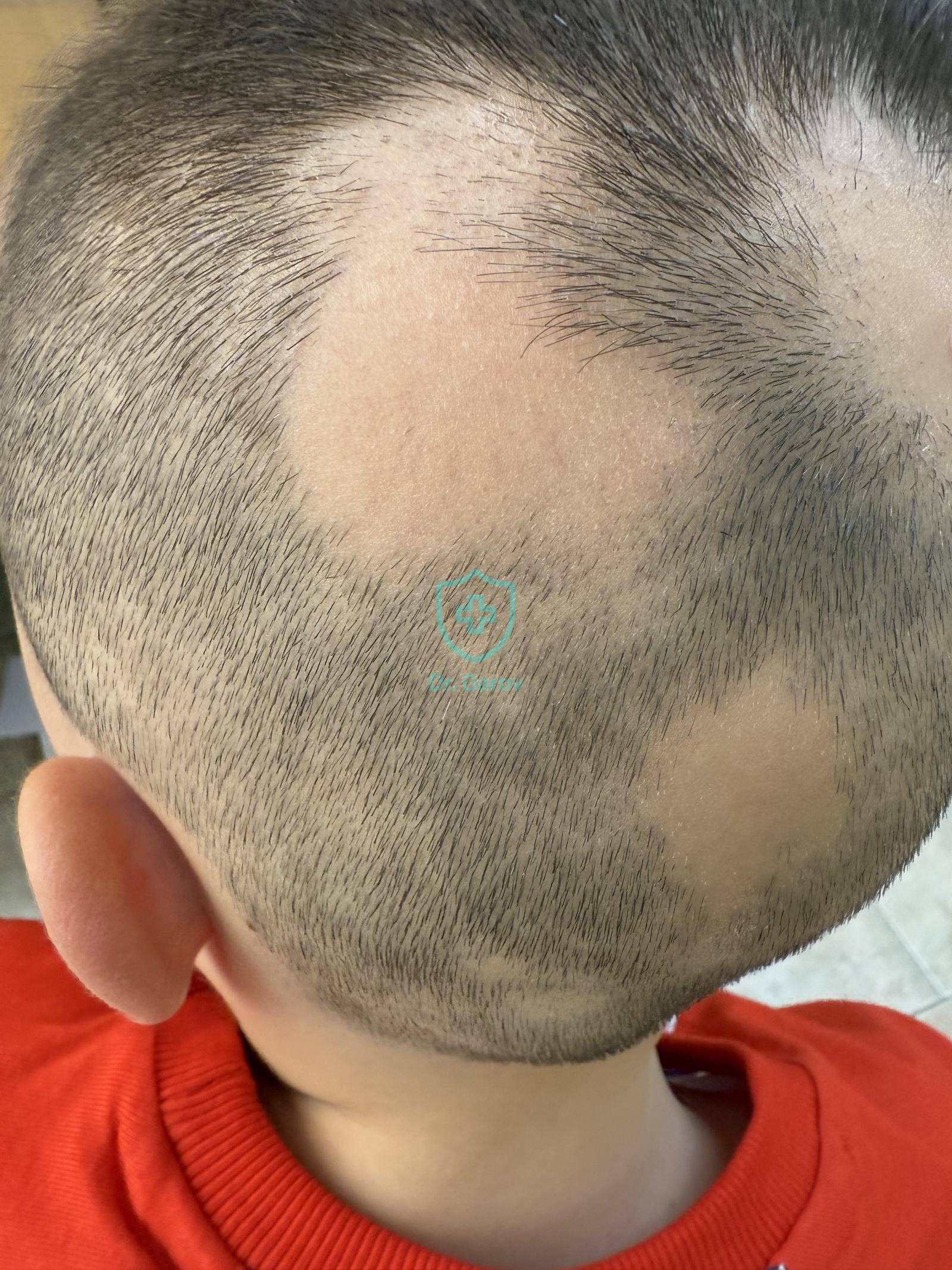 Alopecia areata