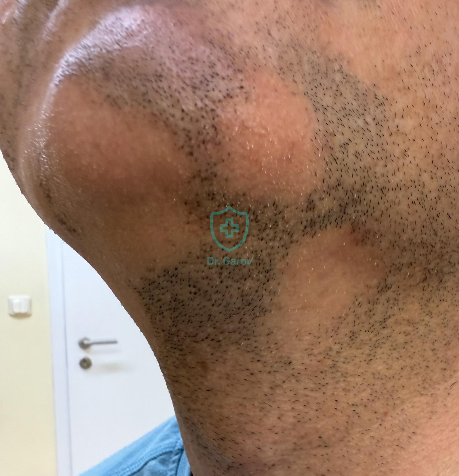 Alopecia areata barbae