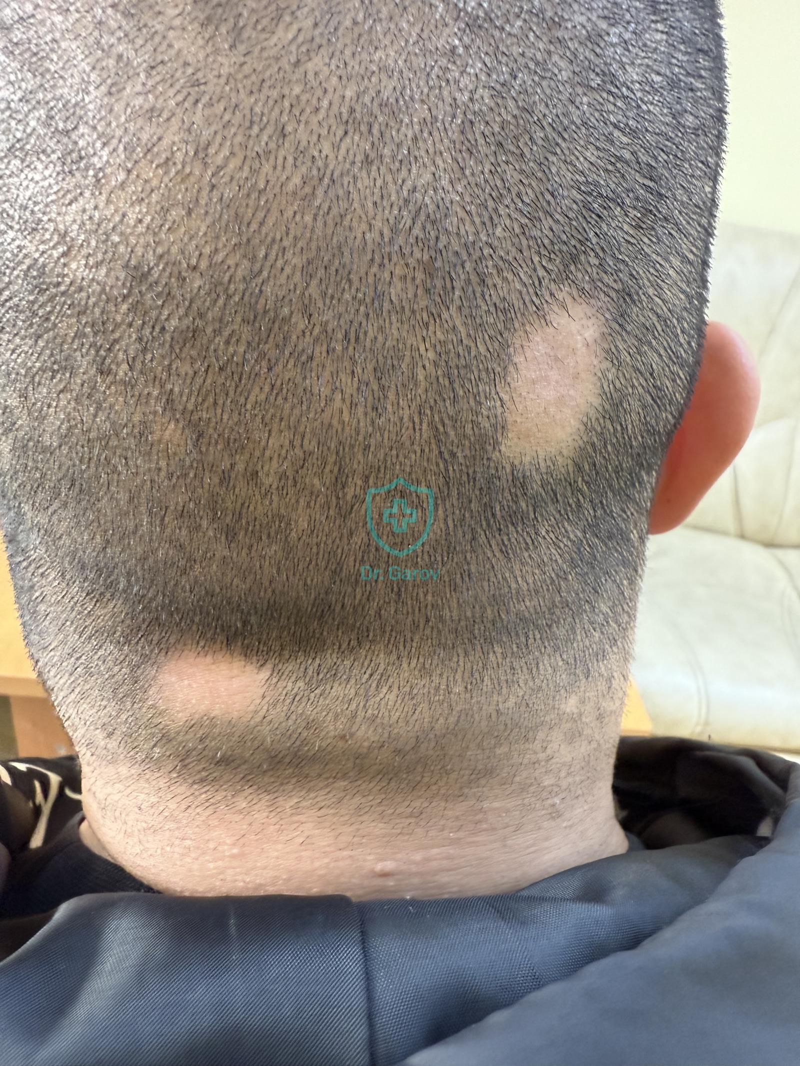 Alopecia areata
