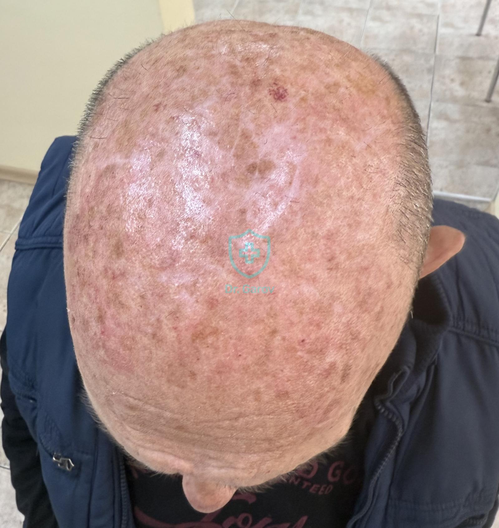 Alopecia androgenica