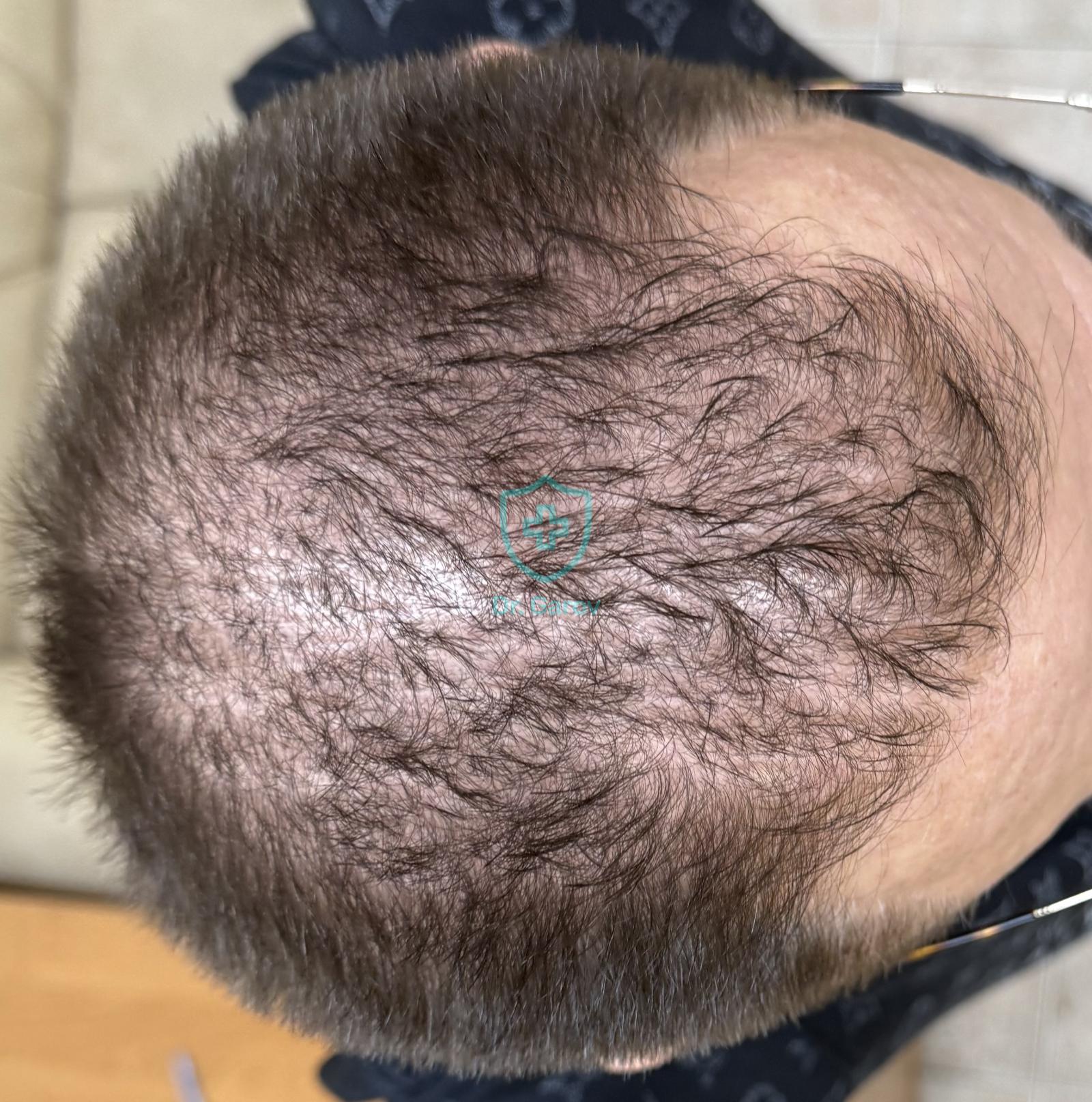 Alopecia androgenica