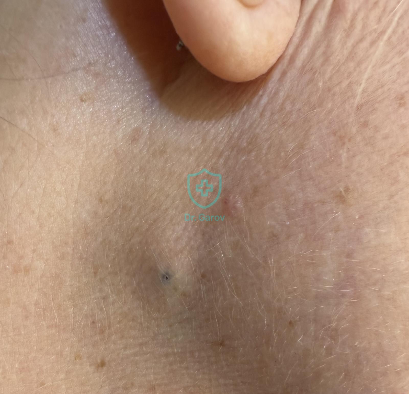 Atheroma