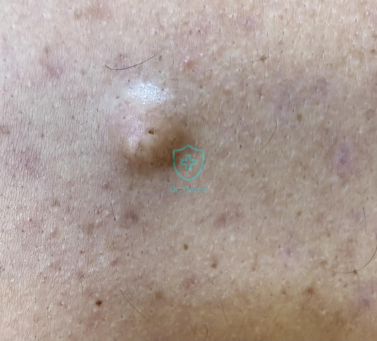 Atheroma