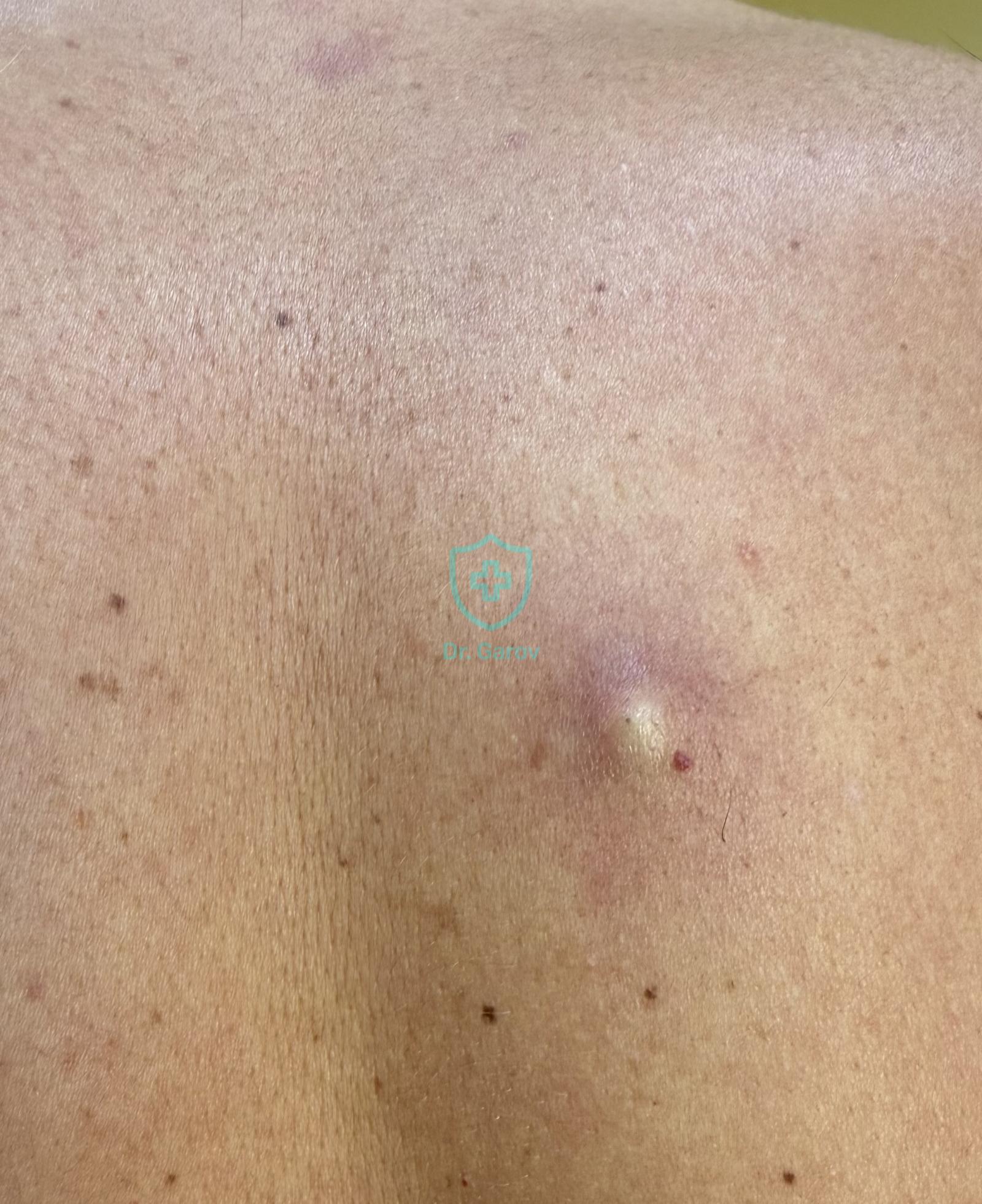 Atheroma