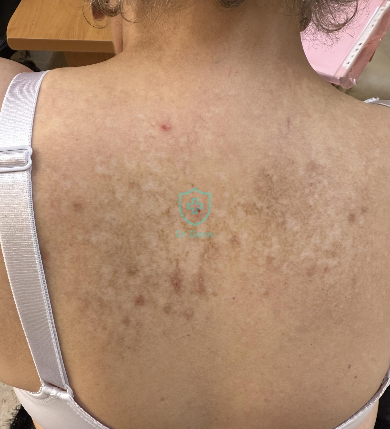 Neurodermitis diffusa