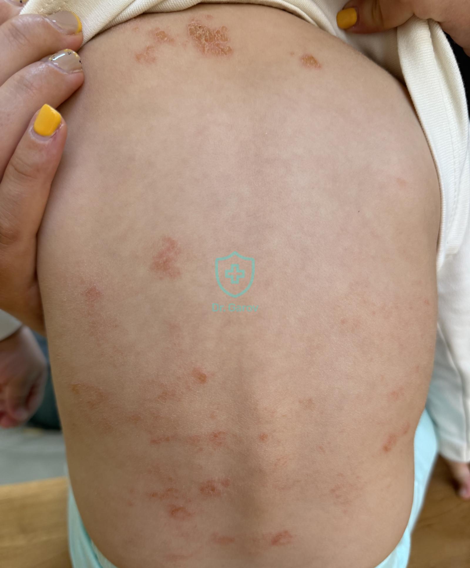 Atopic dermatitis - eczema verum infantum