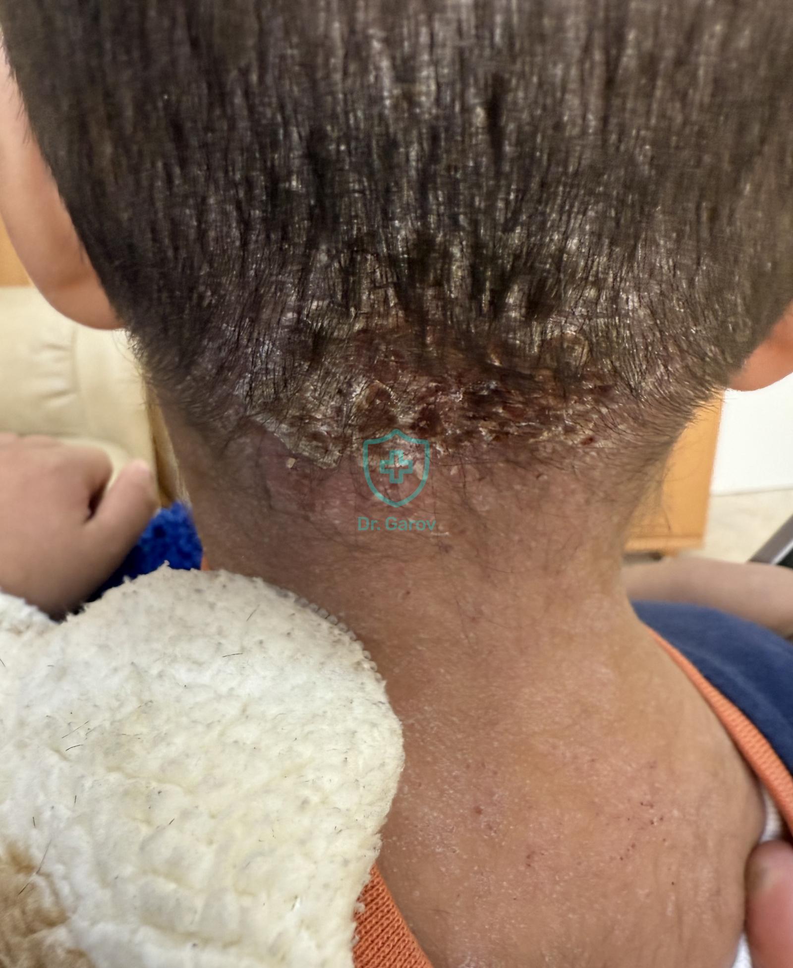 Atopic dermatitis - eczema verum infantum