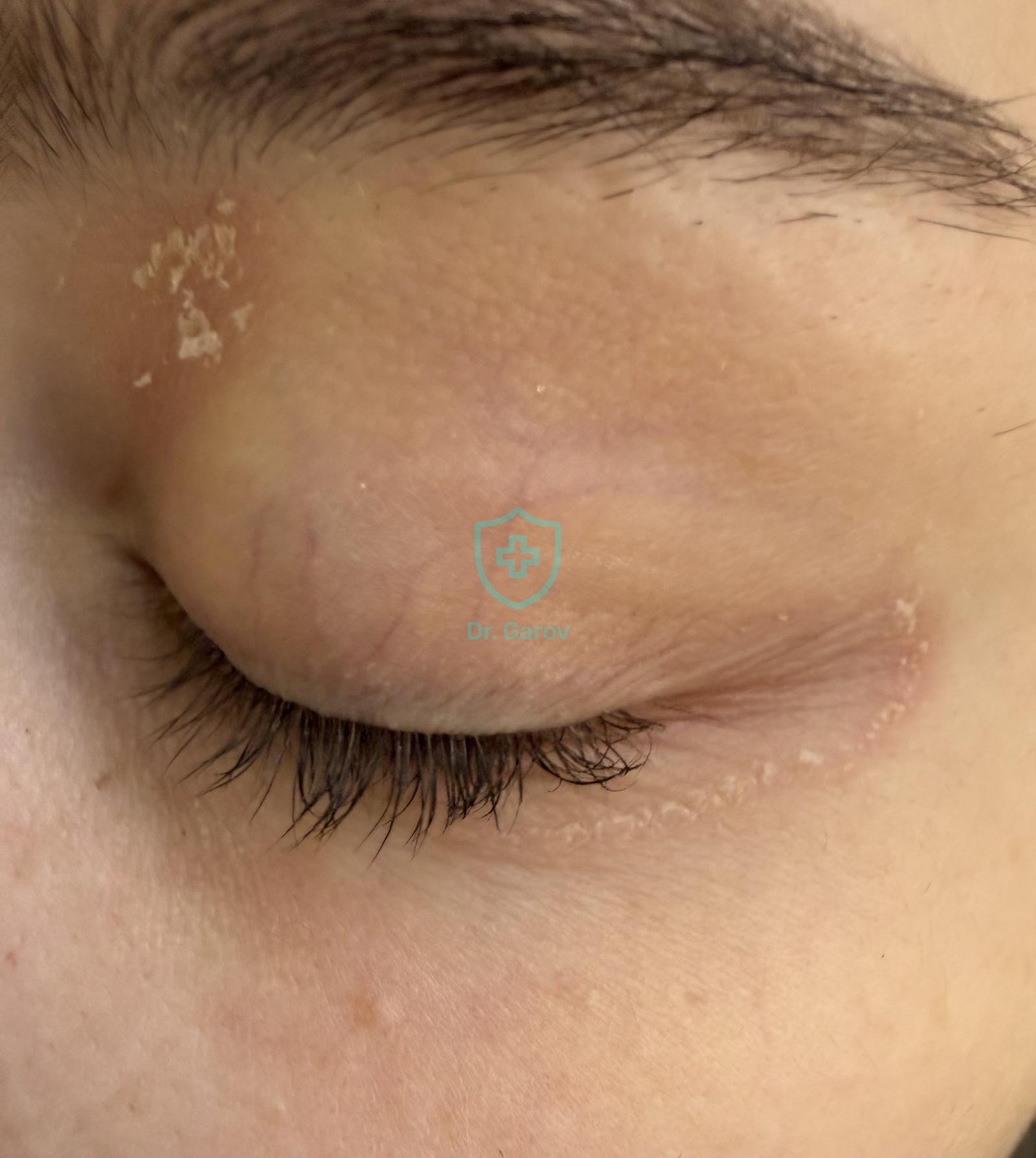 Atopic dermatitis