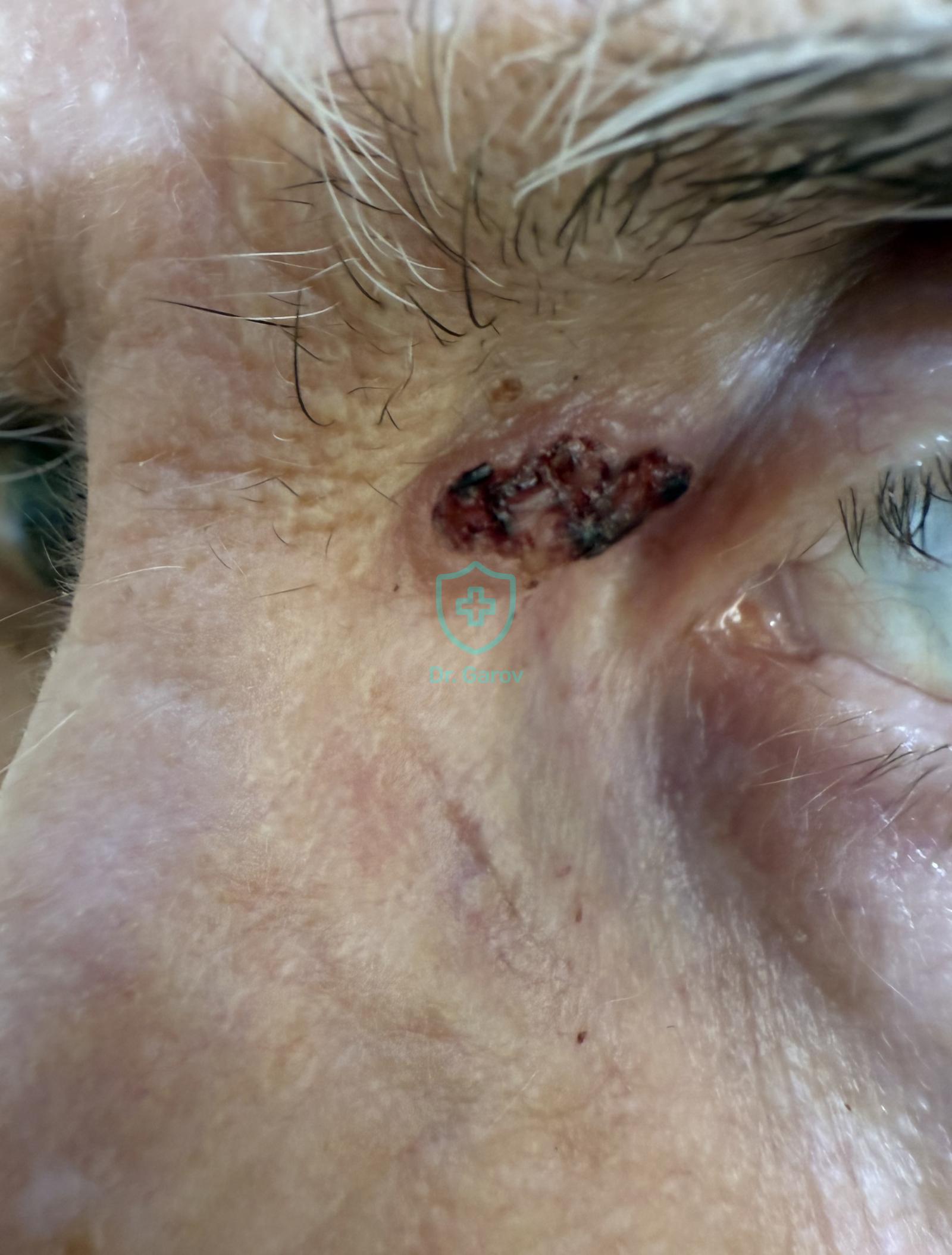 Carcinoma basocellulare