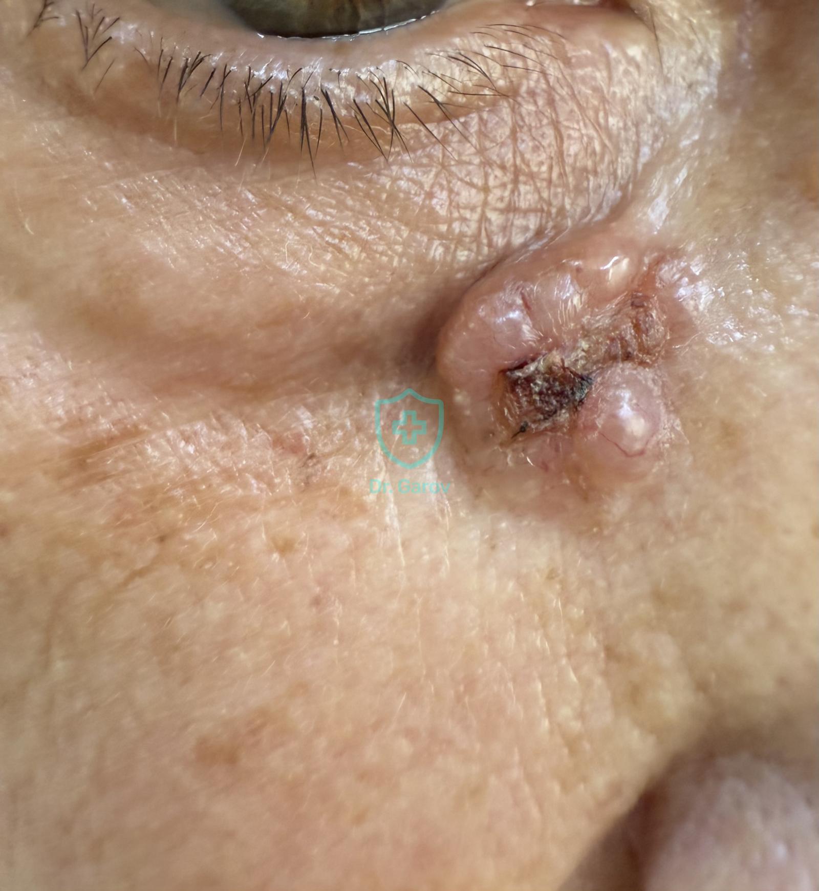 Carcinoma basocellulare