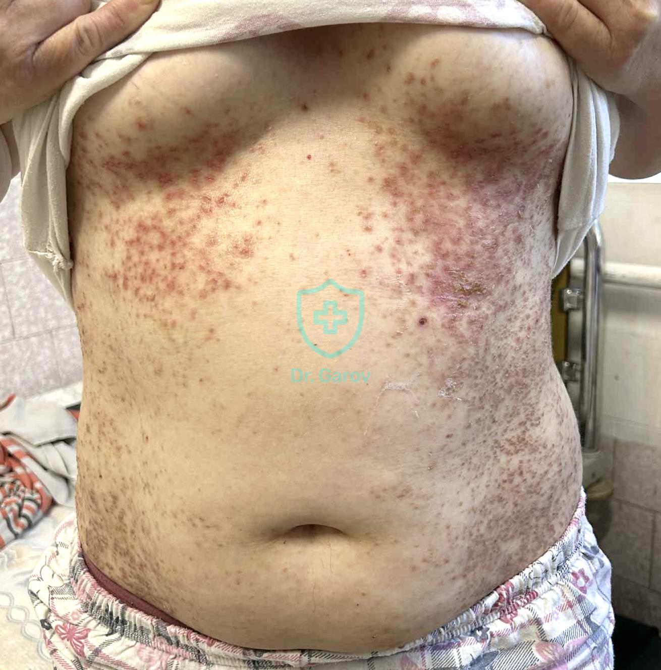 Dyskeratosis follicularis (Мorbus Darier)