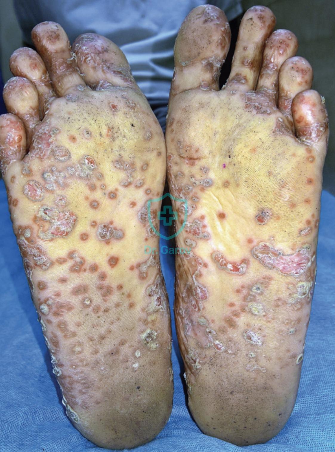 Morbus Reiter - Keratodermia blennorrhagica