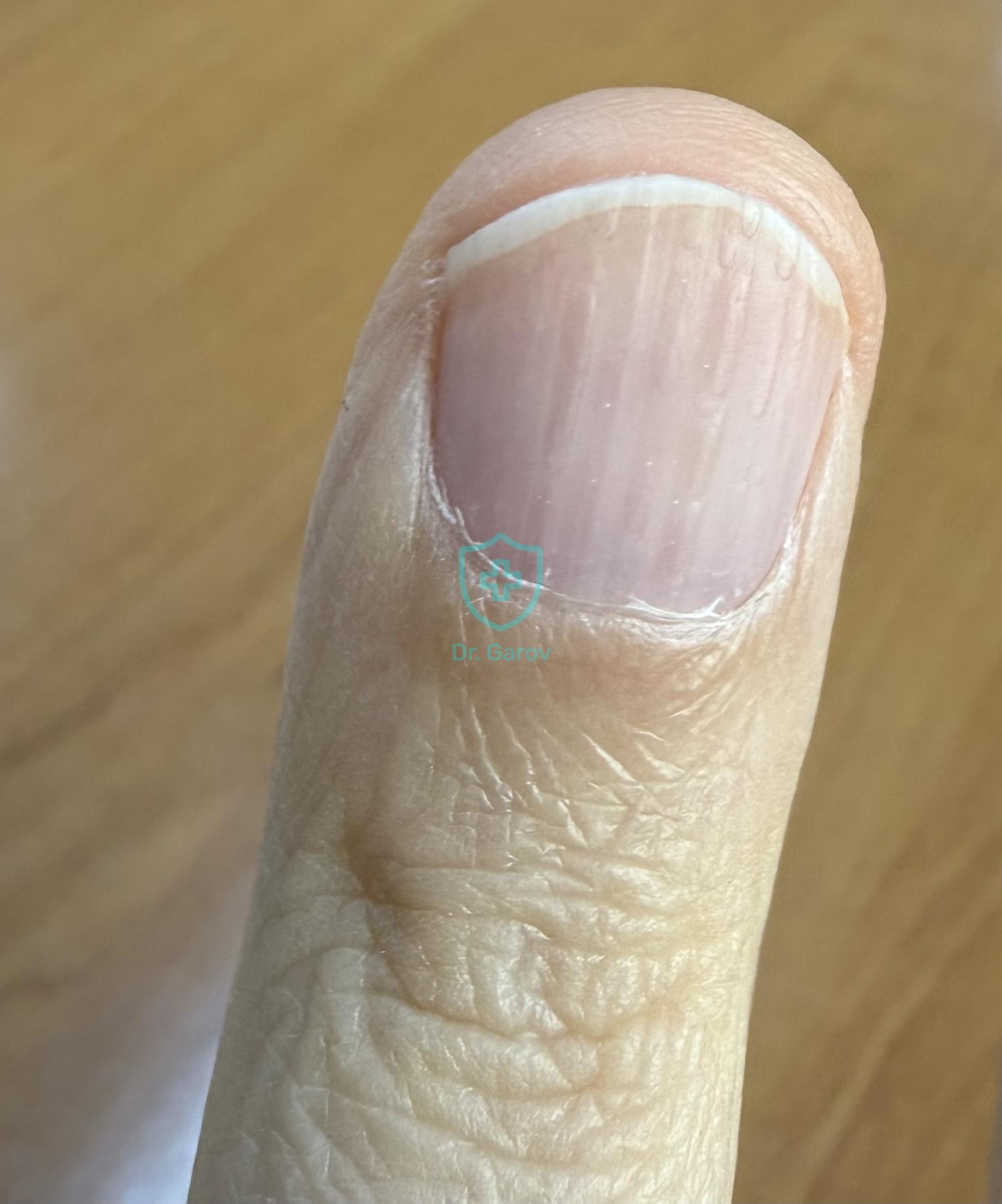 Striae longitudinales