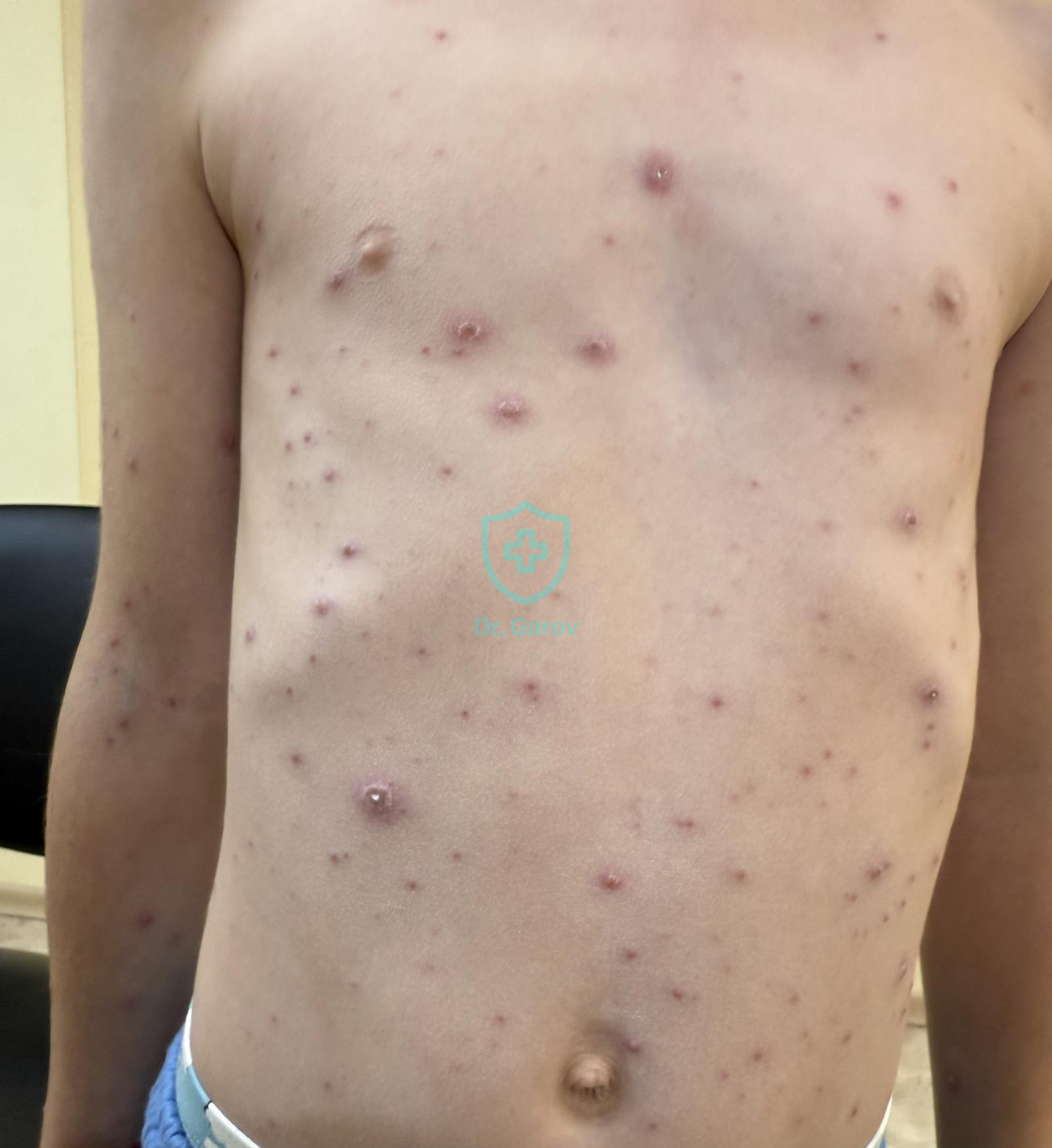 Varicella