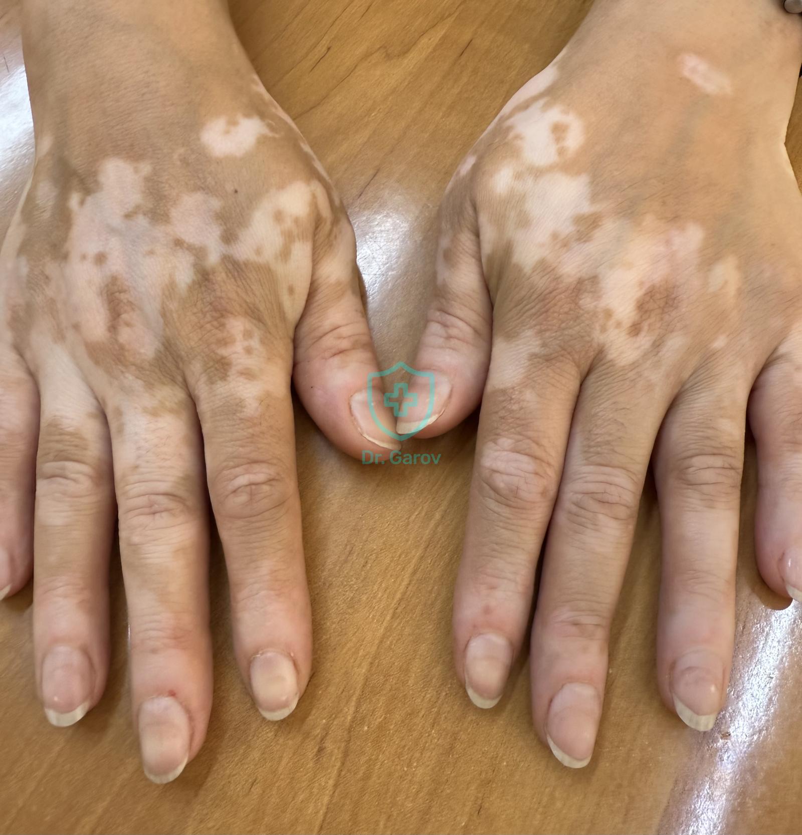 Vitiligo