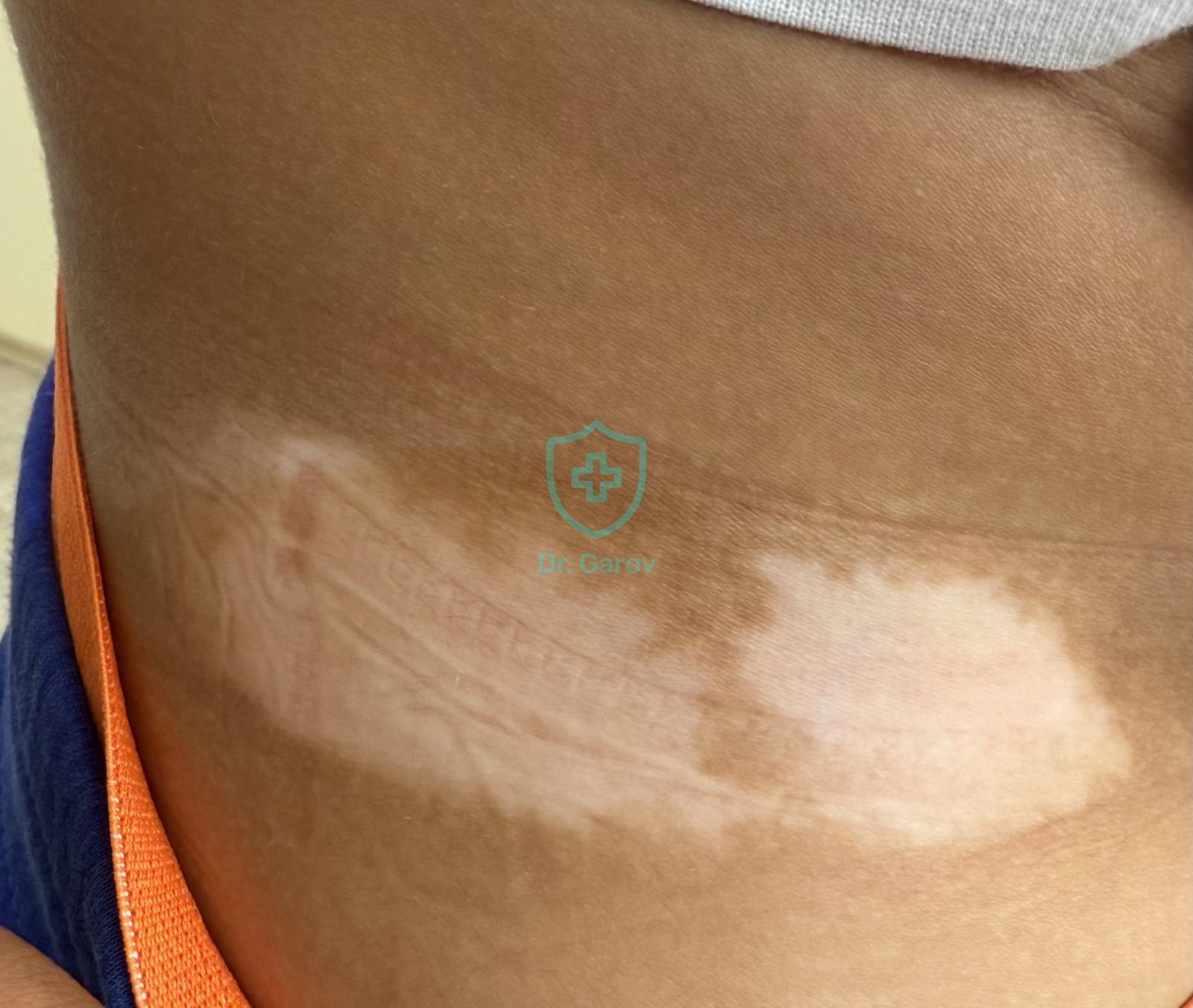 Vitiligo