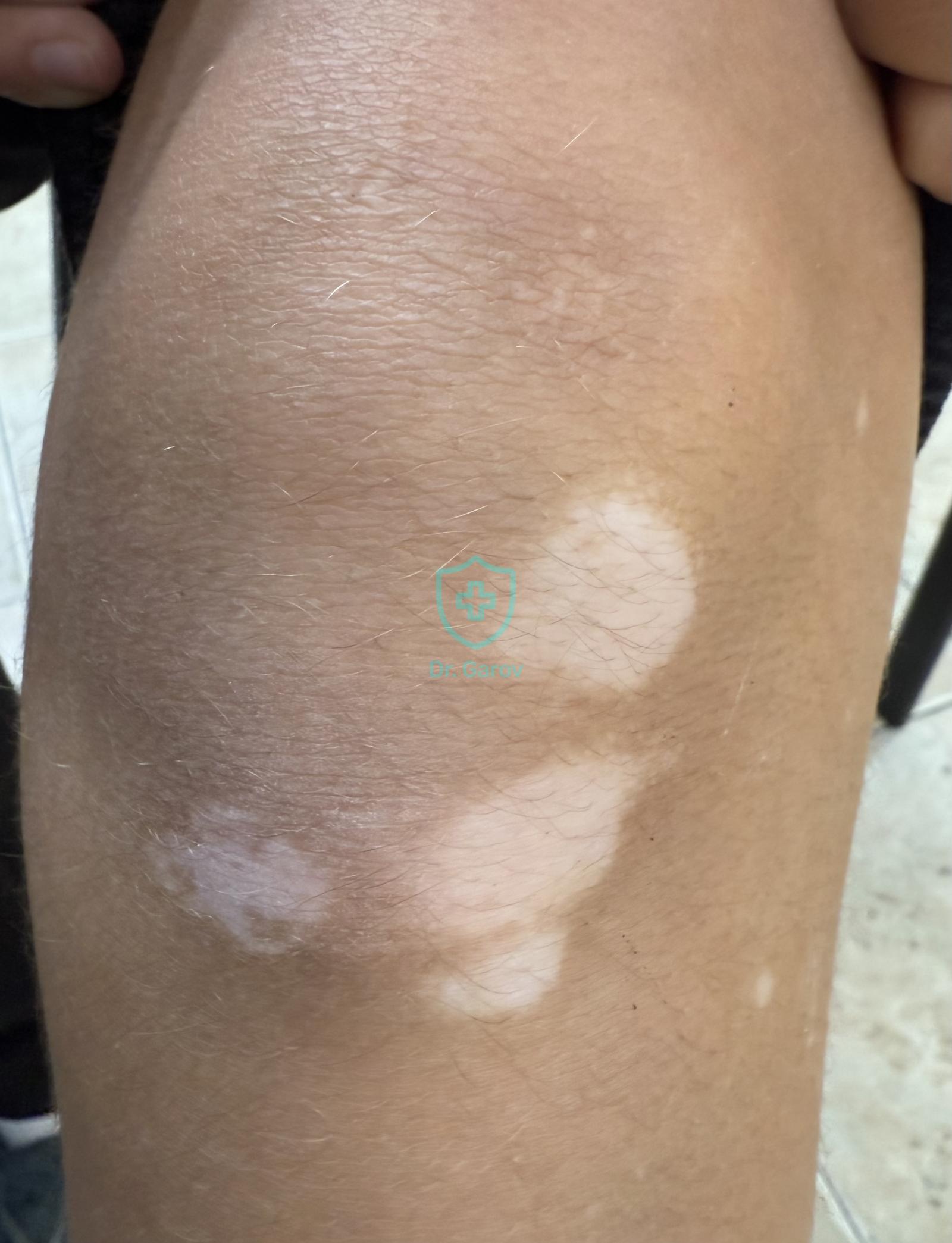 Vitiligo