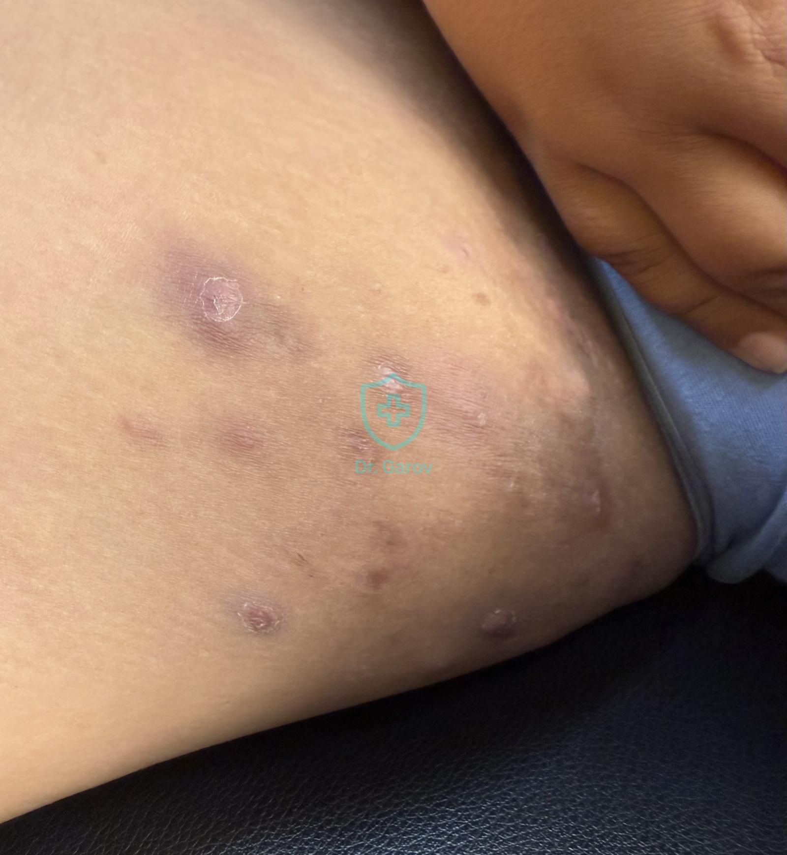 Hidradenitis suppurativa