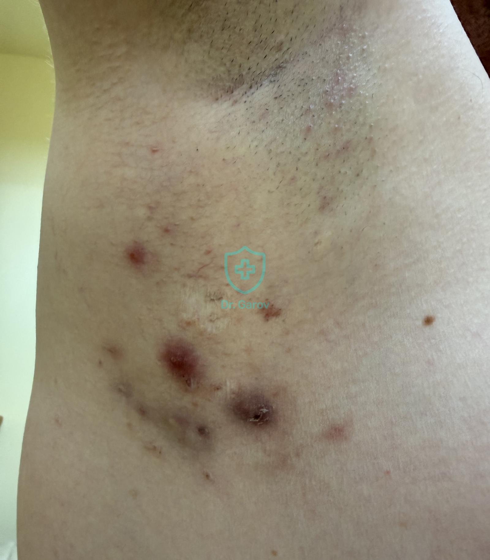 Hidradenitis suppurativa
