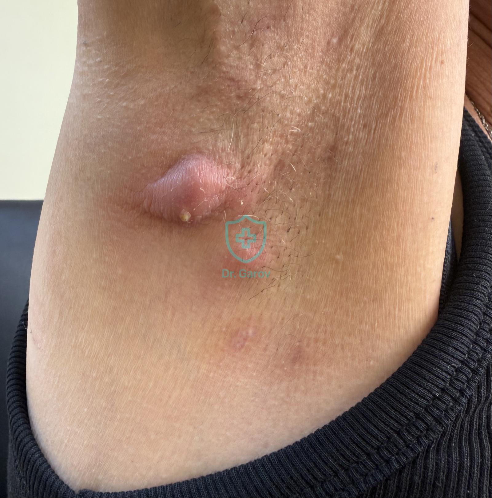 Hidradenitis suppurativa