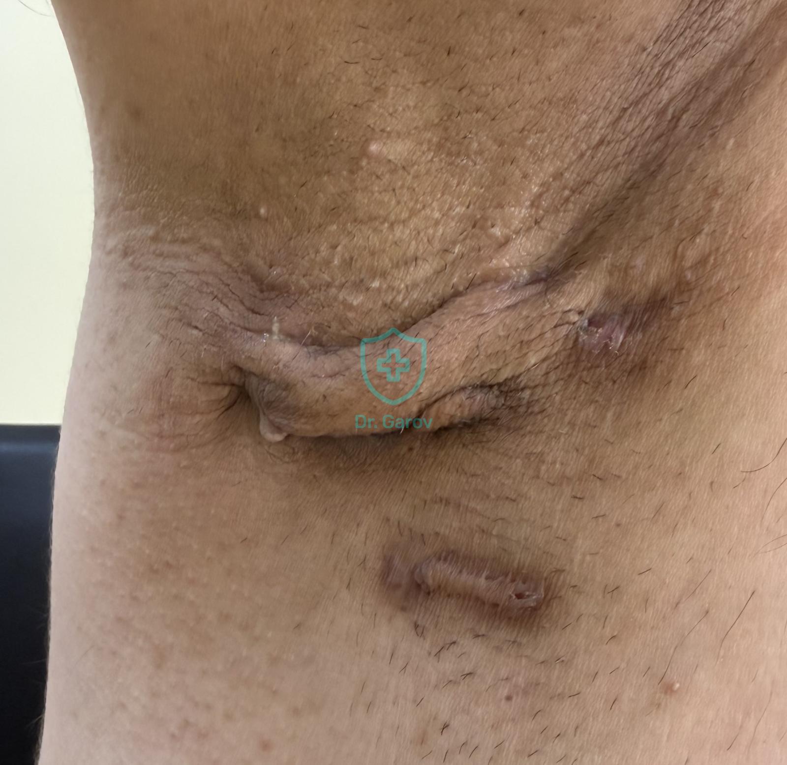 Hidradenitis suppurativa