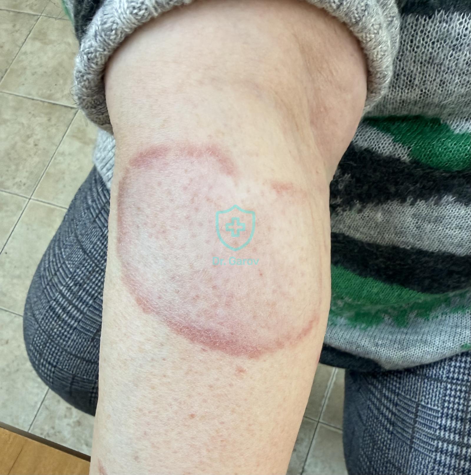 Granuloma annulare