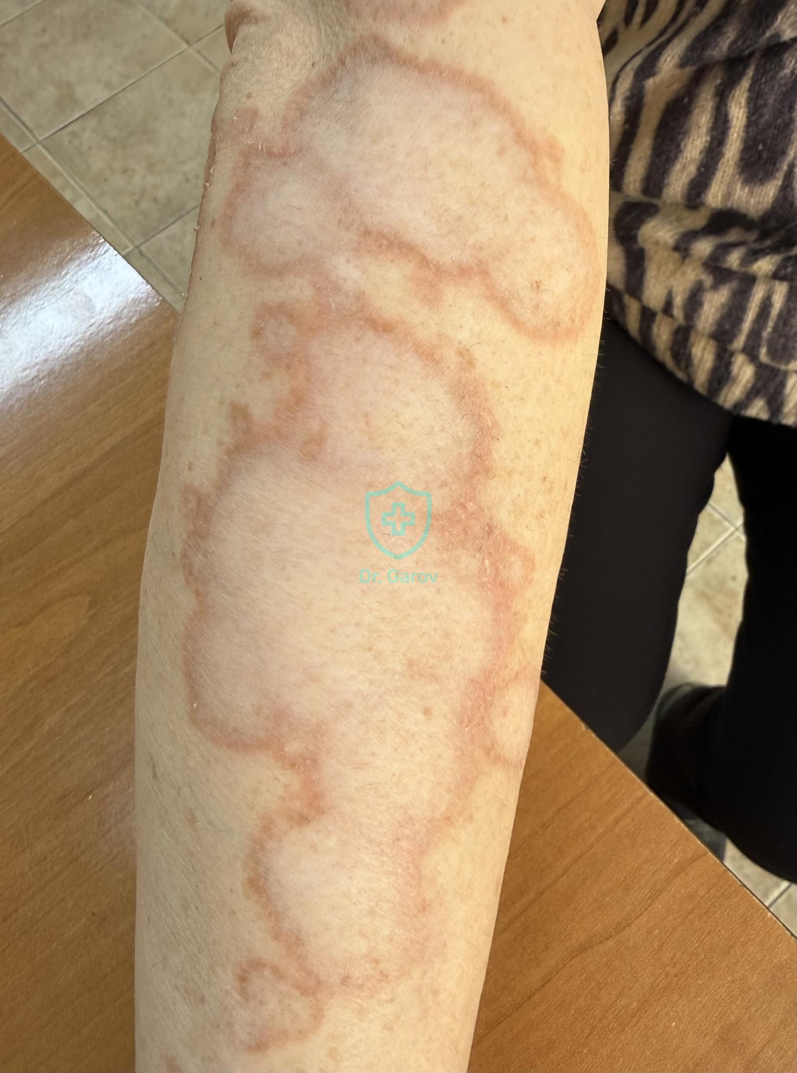 Granuloma annulare
