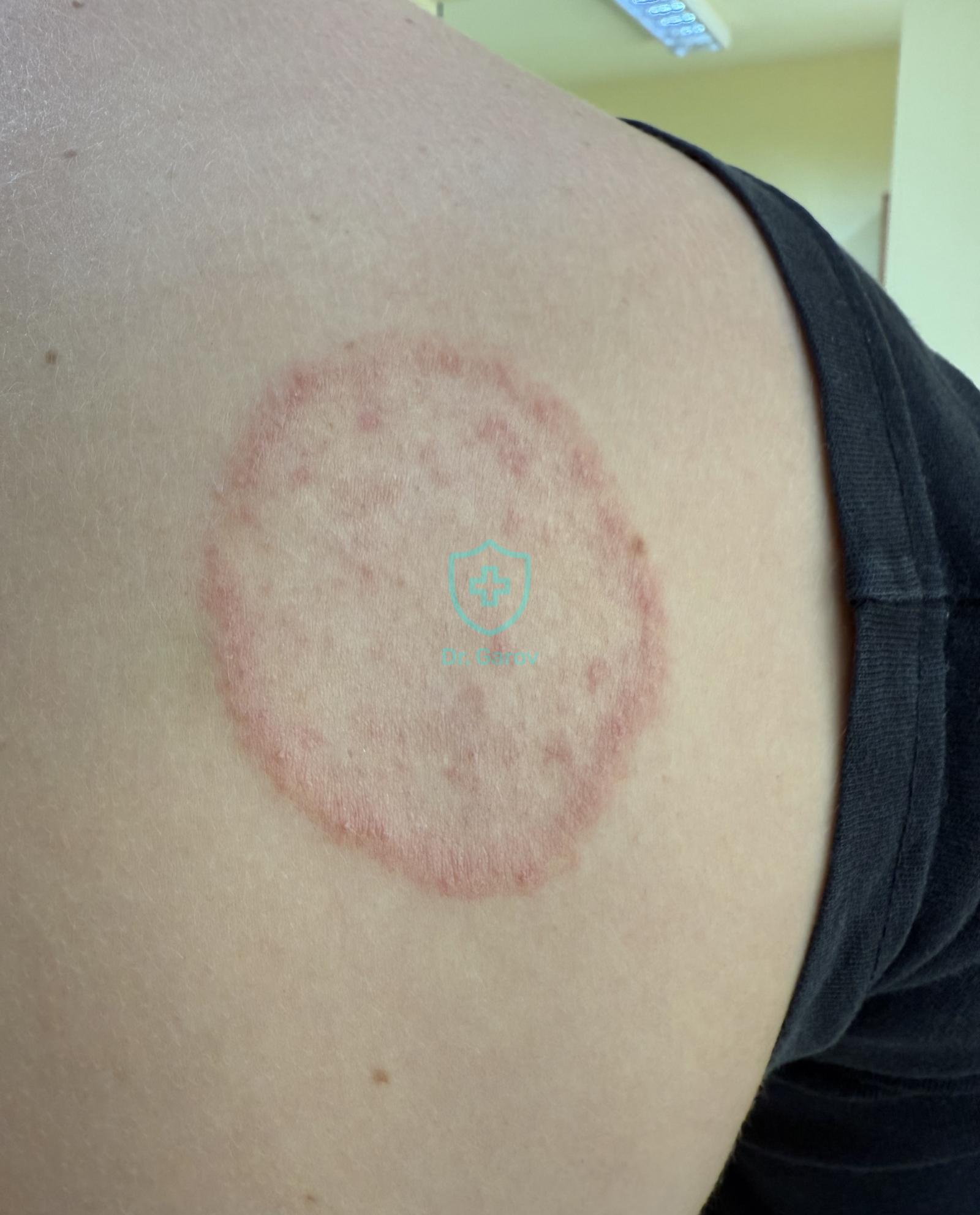 Tinea cutis glabrae