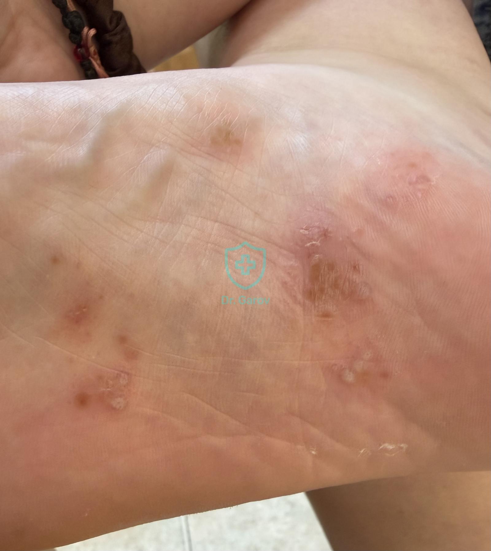 Tinea pedum