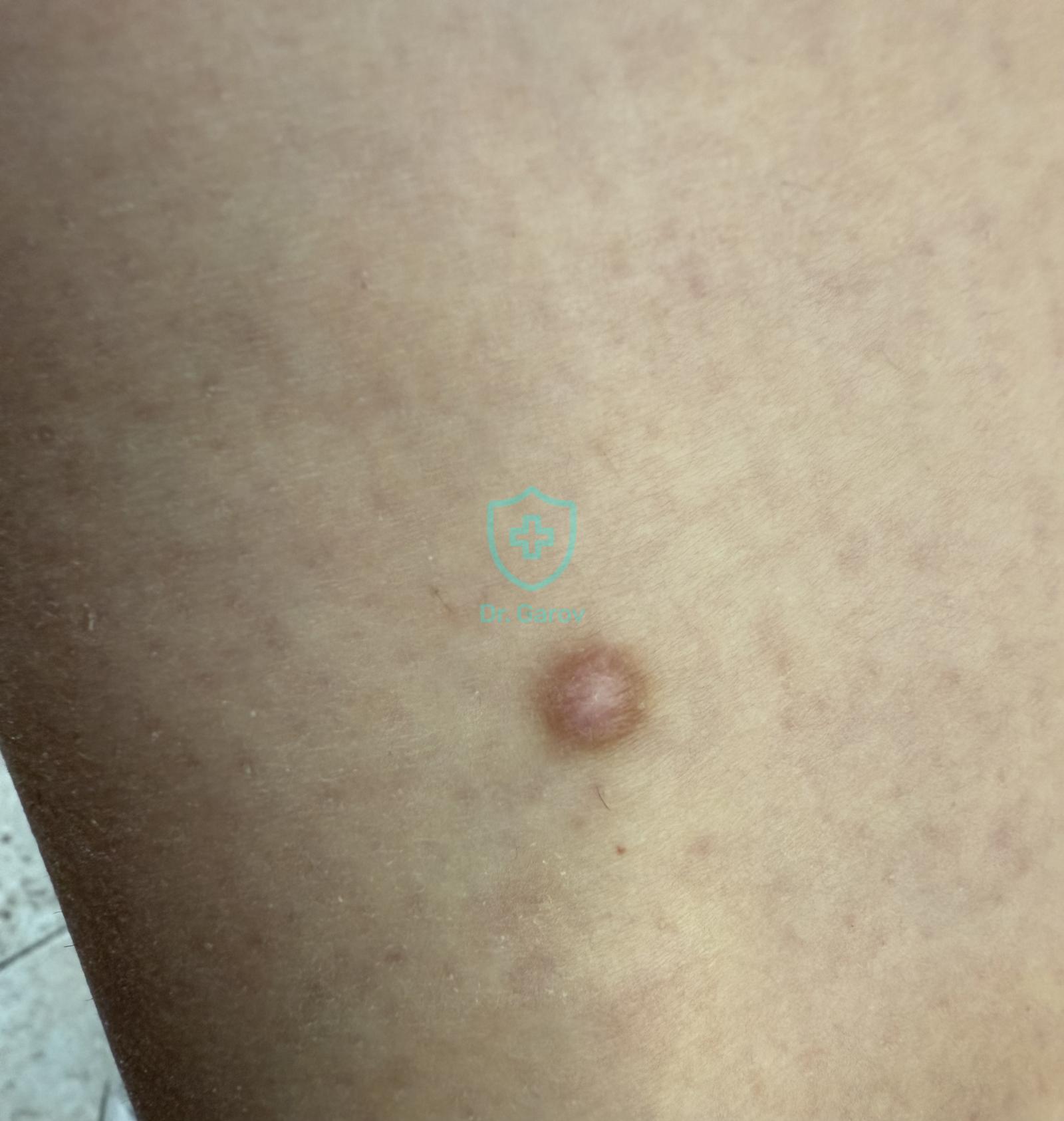 Dermatofibroma, Histiocytoma