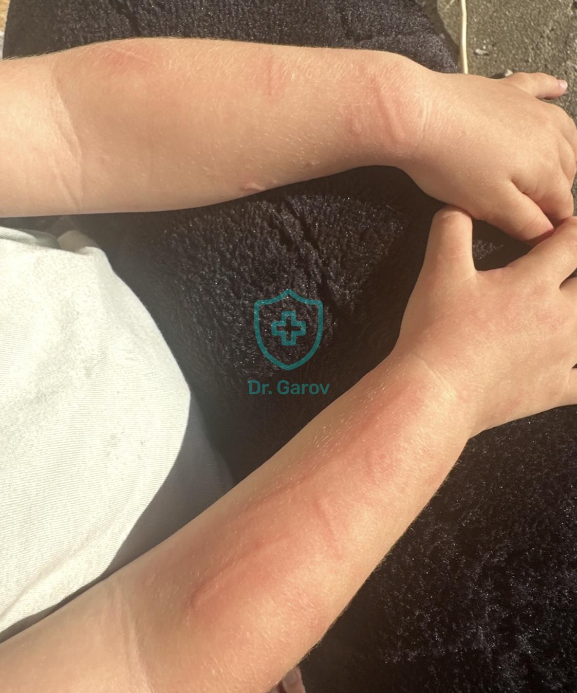 Urticaria factitia