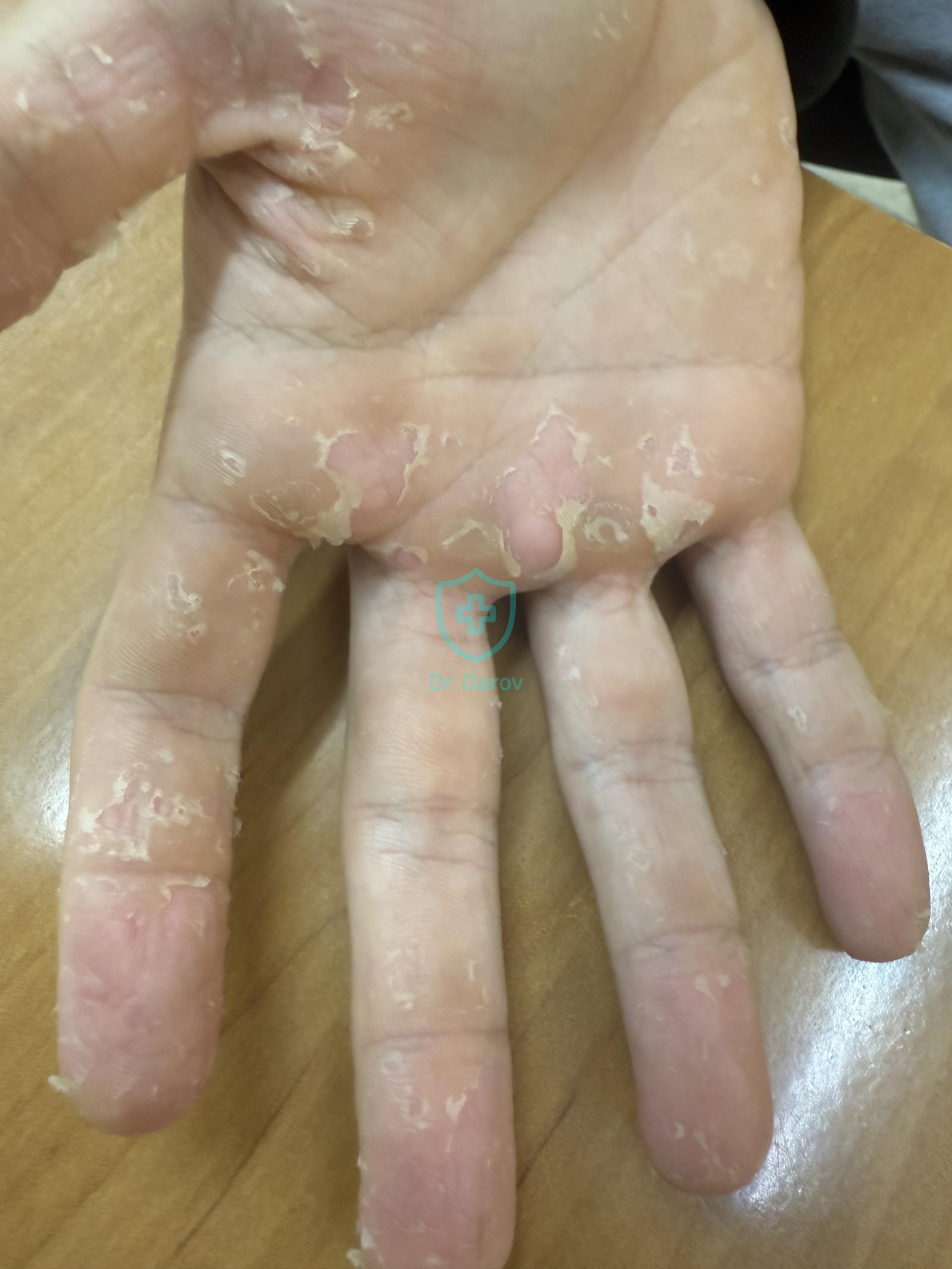 Dyshidrosis lamellosa sicca