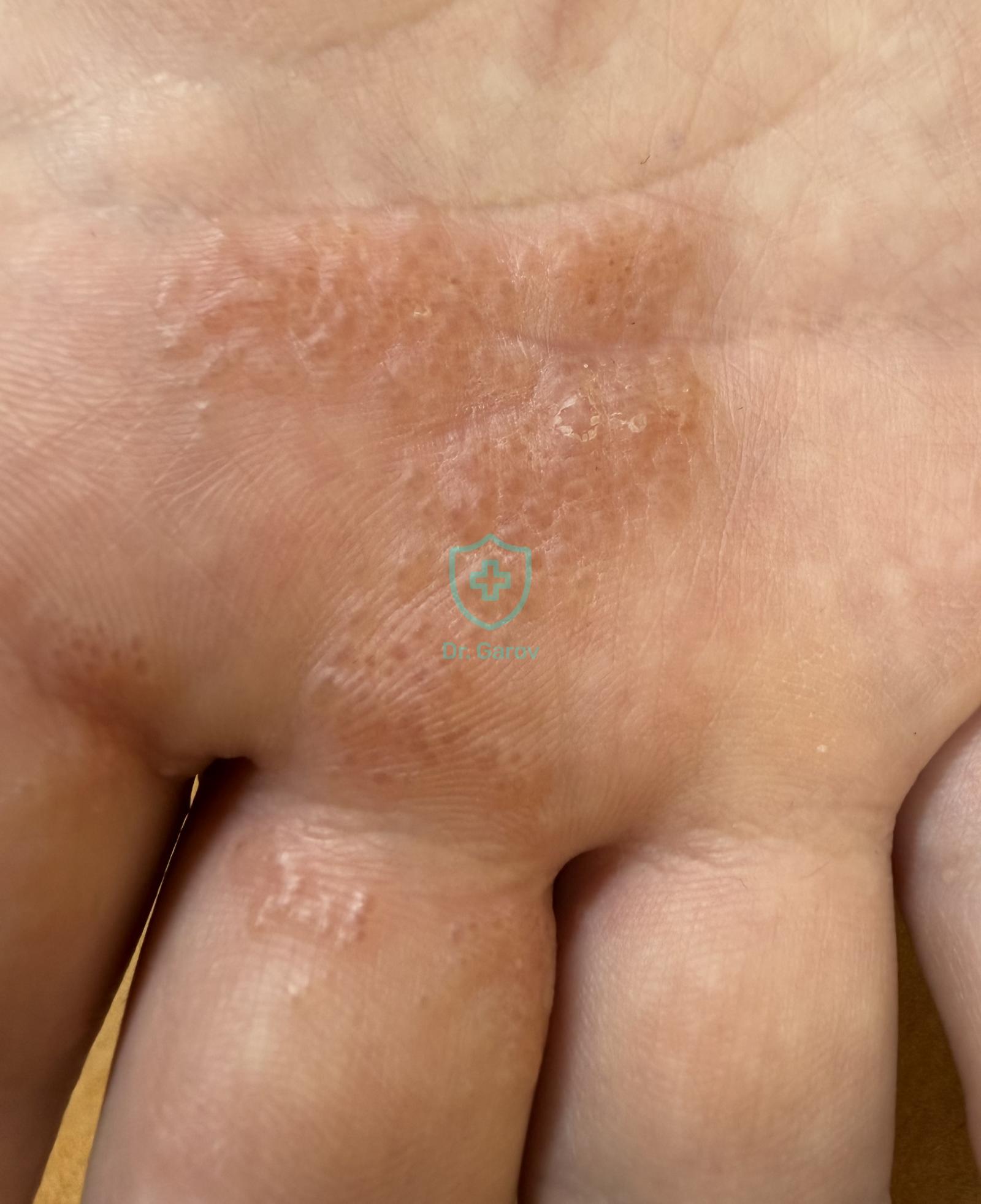 Dyshidrosis, Eczema dyshidrosiforme