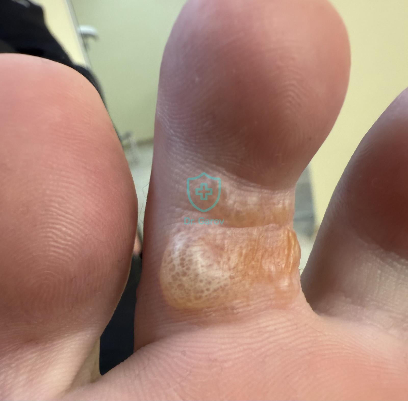 Dyshidrosis, Eczema dyshidrosiforme