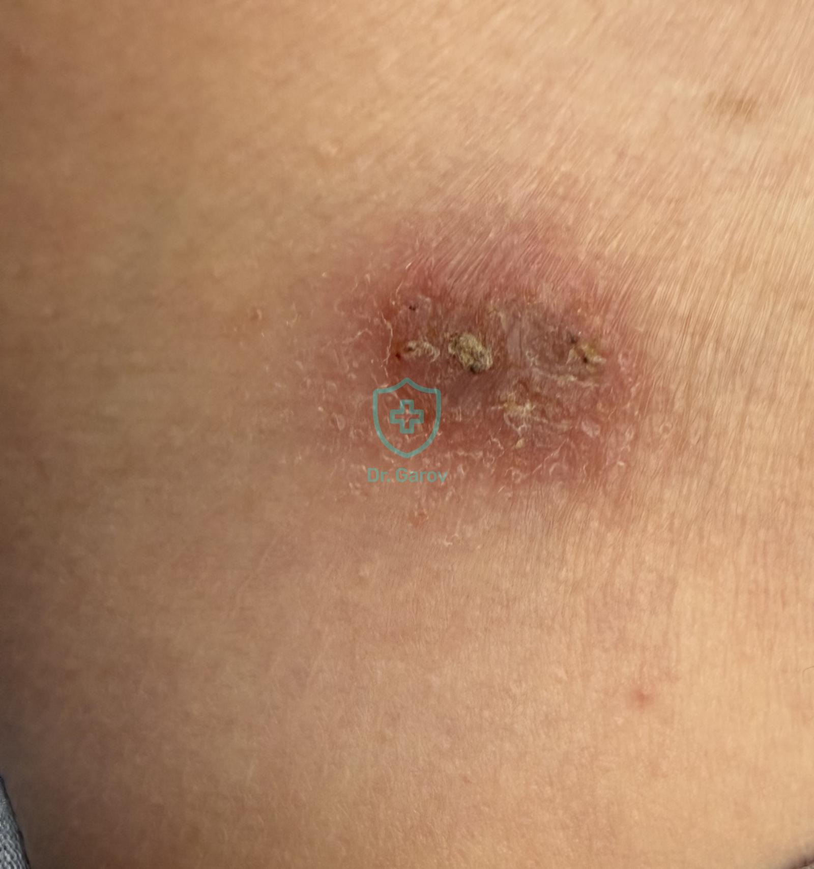 Eczema microbiens