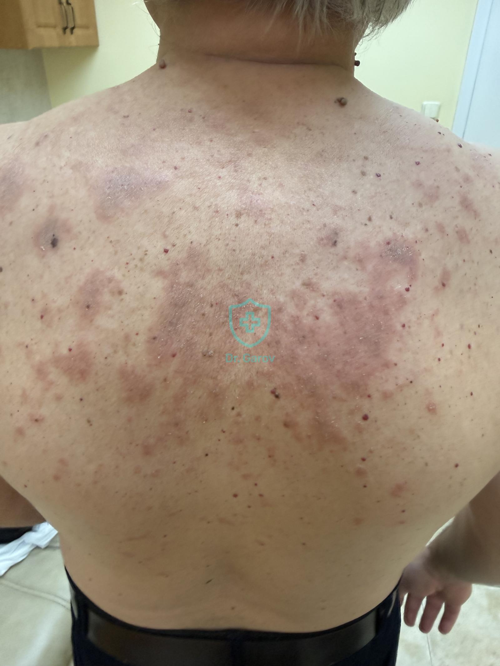 Eczema chronicum exacerbatum