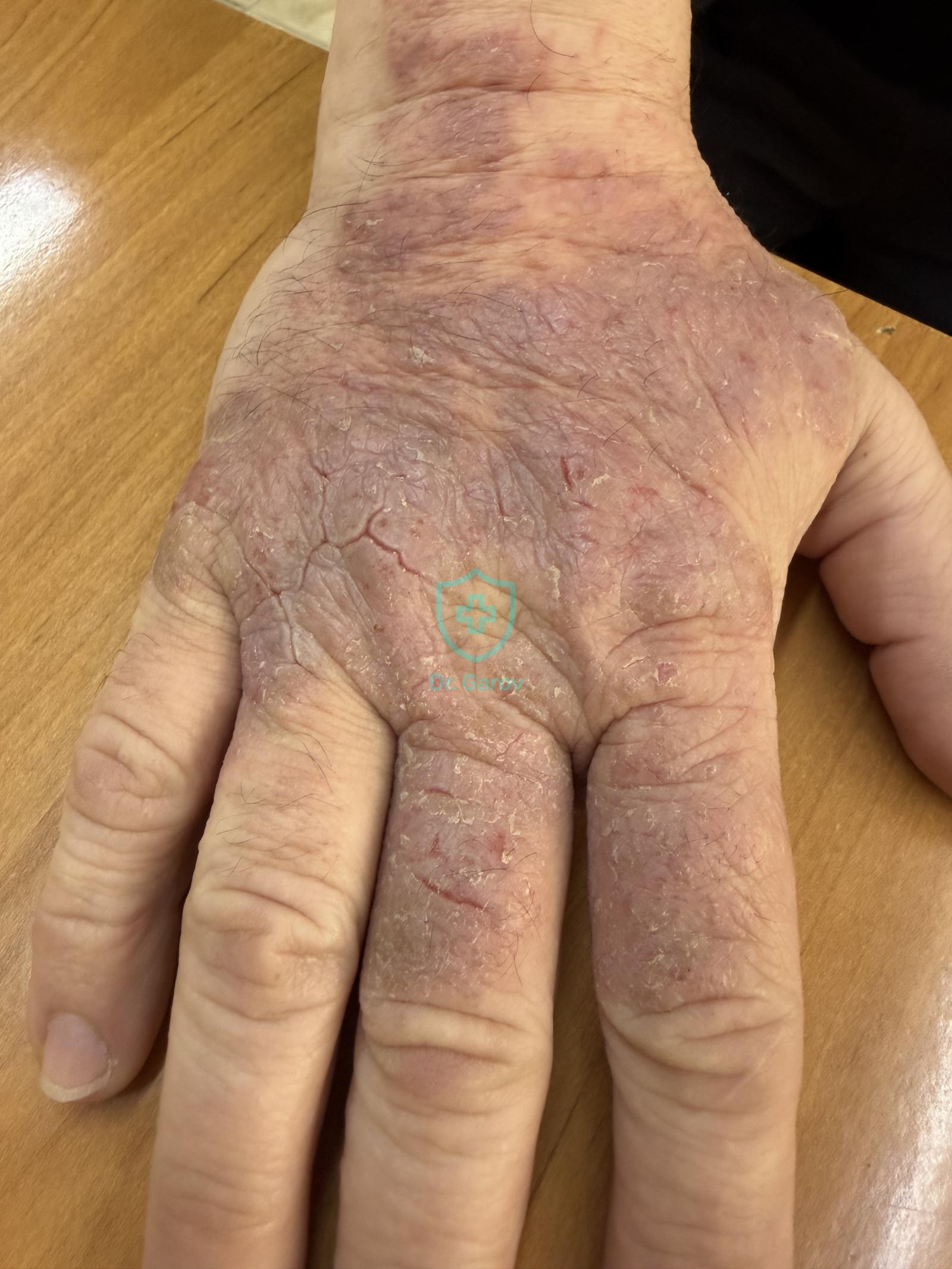 Eczema chronicum exacerbatum