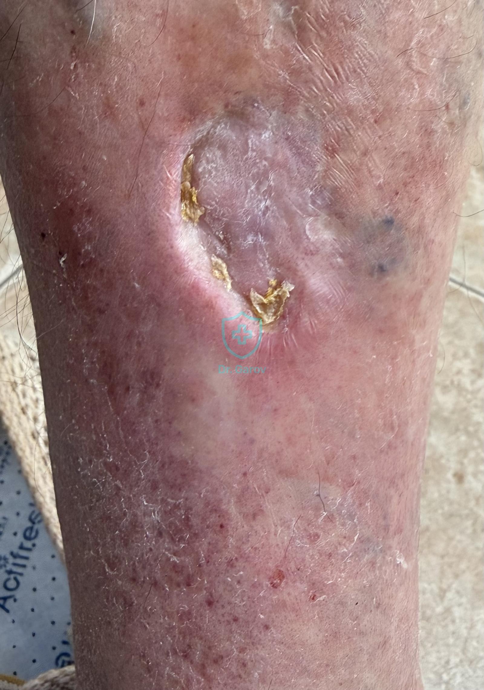 Eczema paratraumaticum