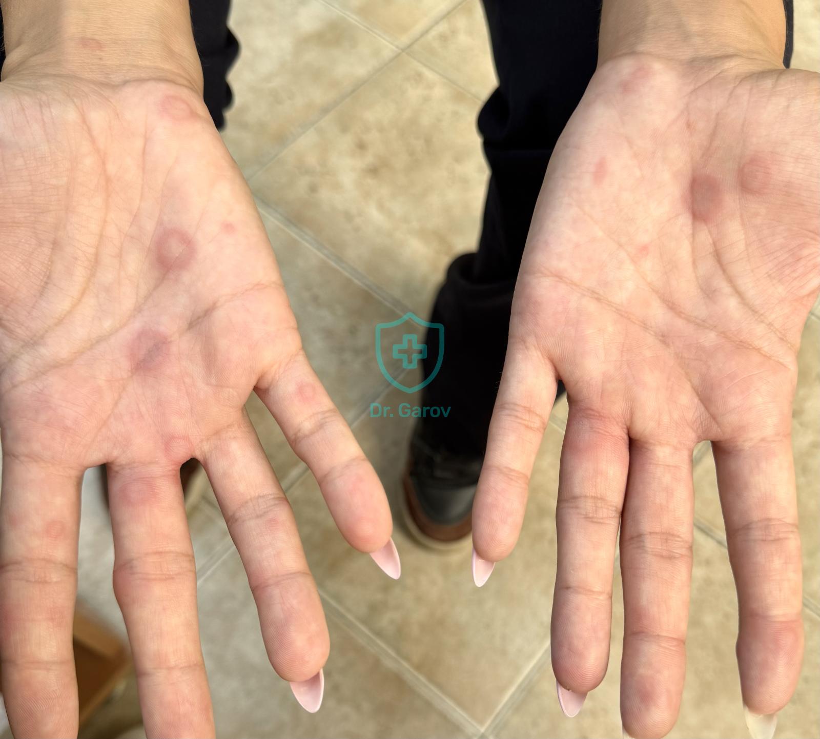 Erythema exsudativum multiforme